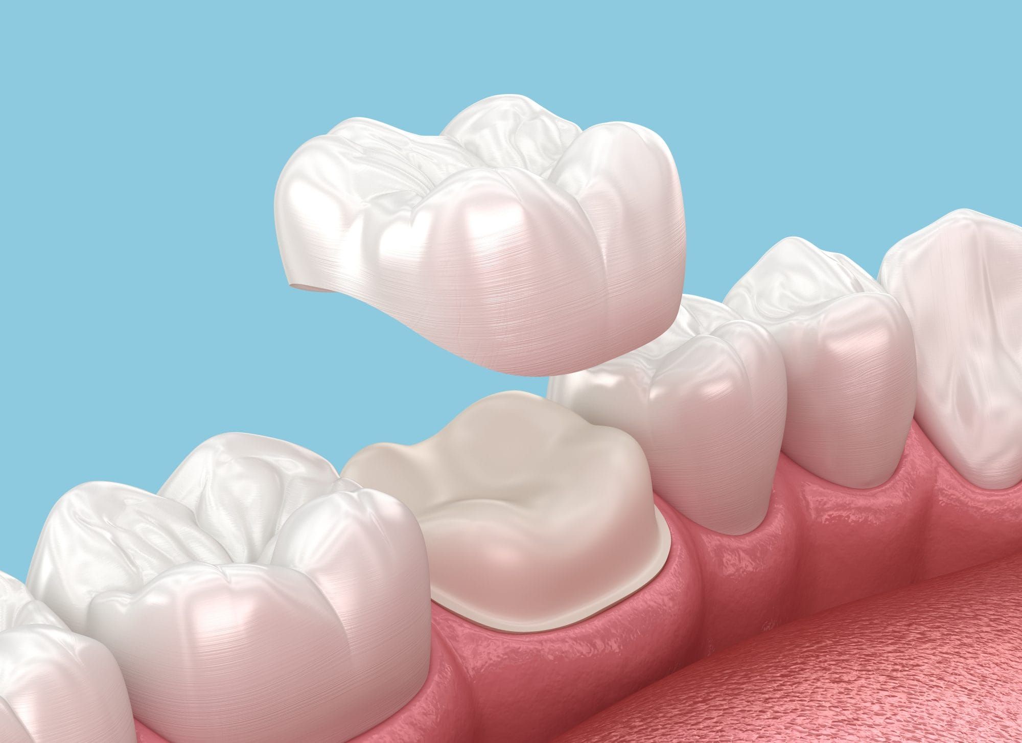 Union Smiles Family Dental Facebook ad: Dental Crowns Union City NJ, Restore Your Smile and…