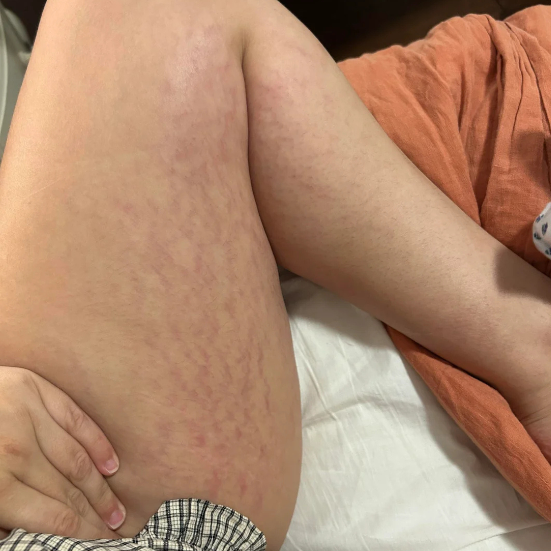 Haedn Gesser Facebook ad: Read If You Struggle With Stretch Marks