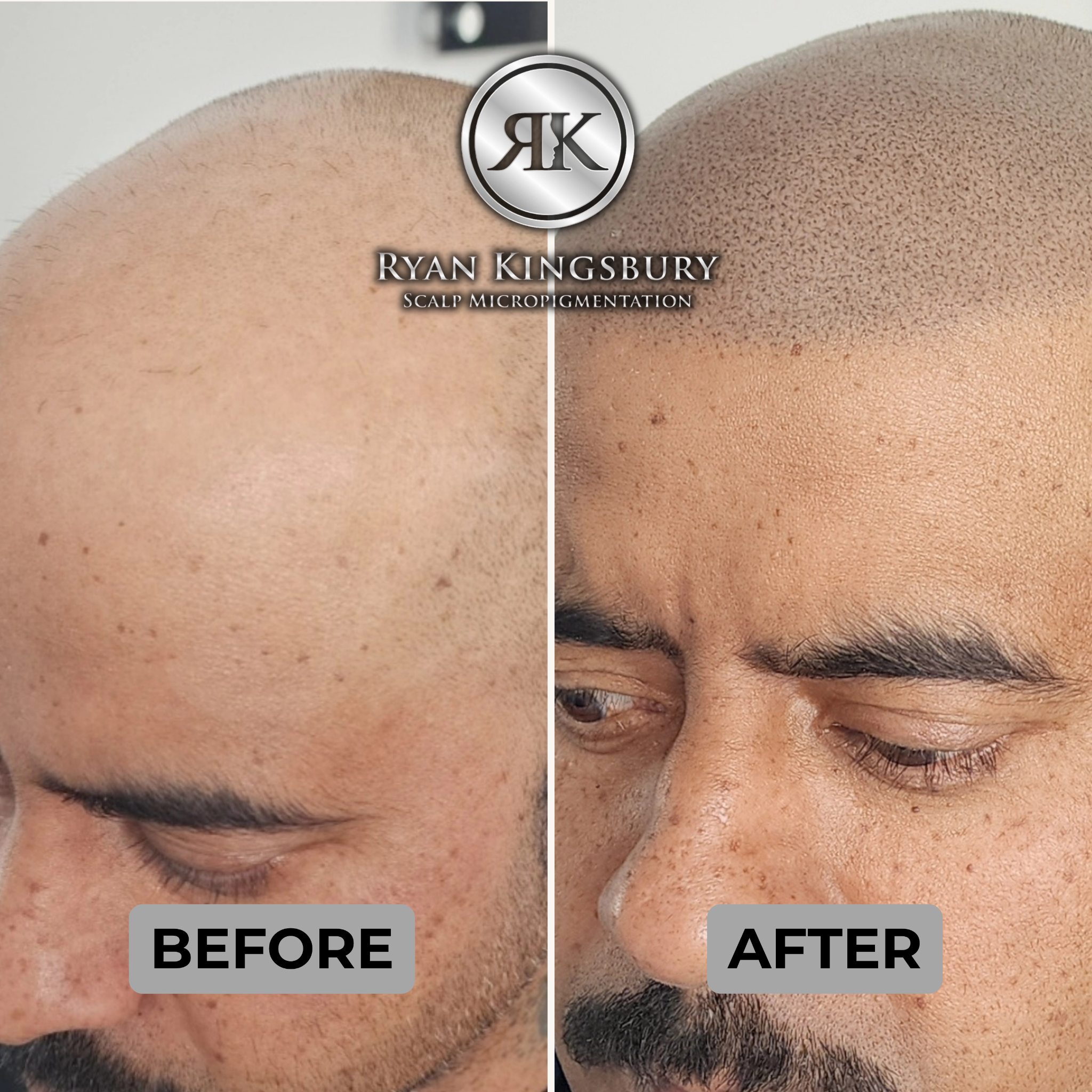 RK Scalp Micropigmentation Facebook ad