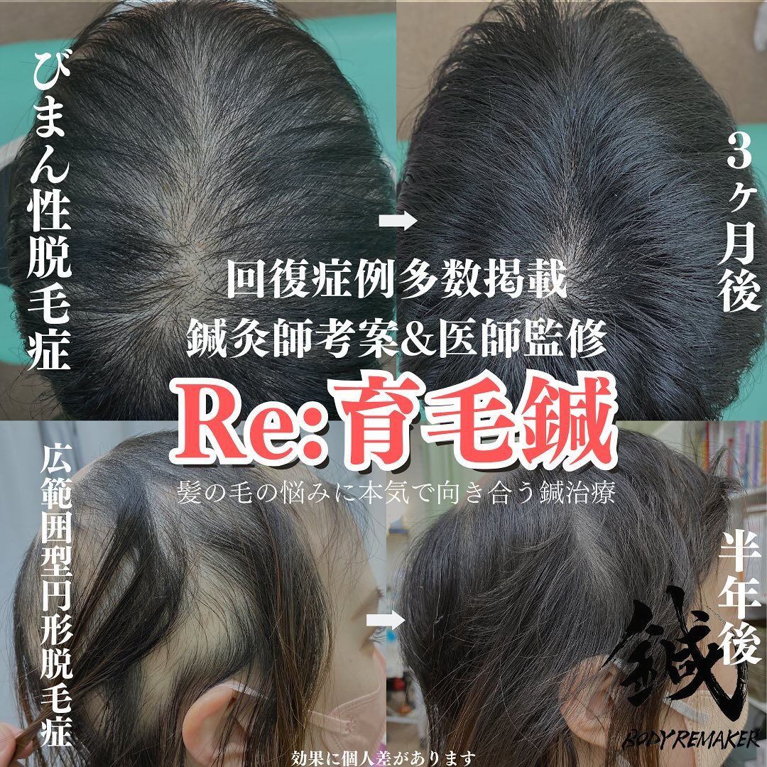 toyota_acupuncture_hal Facebook ad: 【回復症例多数の最新鍼治療】