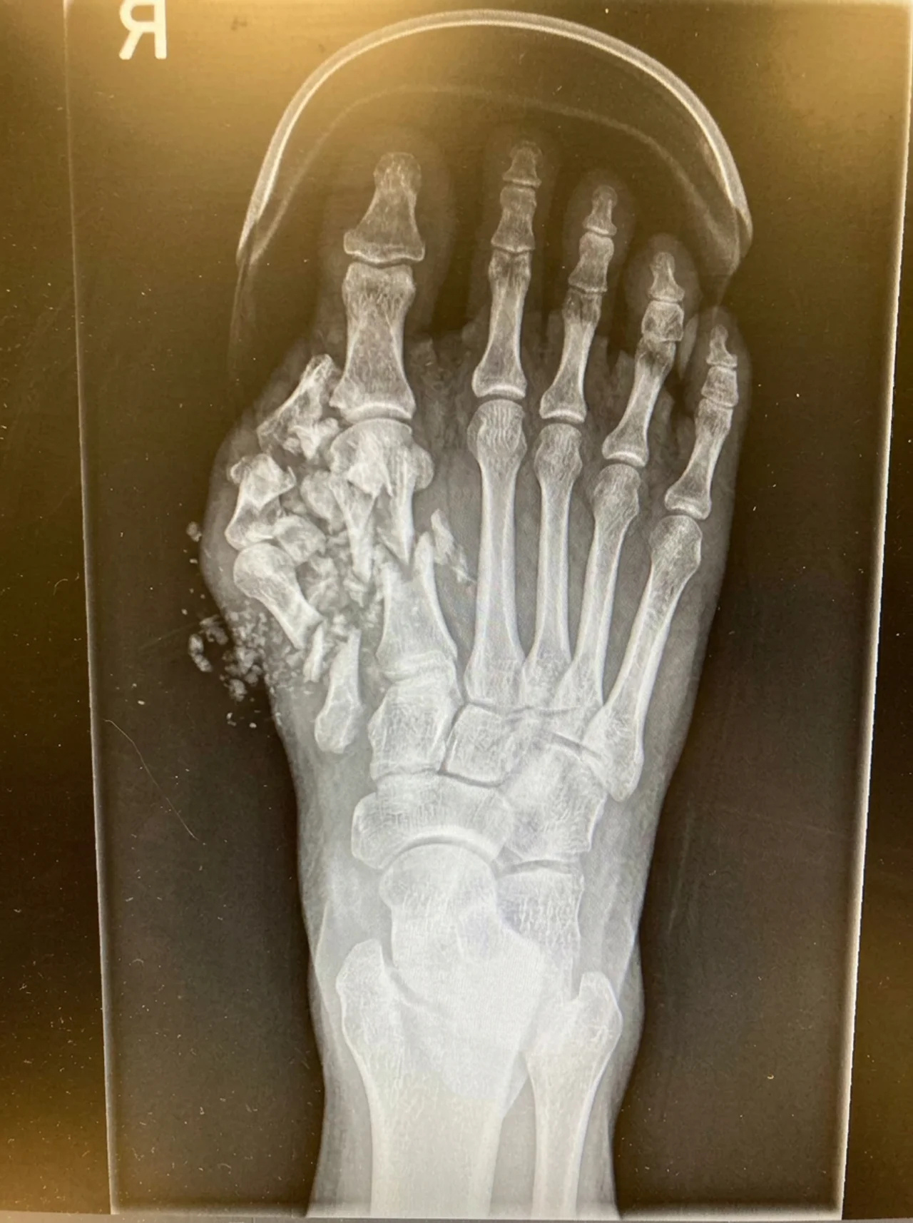 Dr. Elliot Johnson Facebook ad: Neurologist: Neuropathy Isn't A Pain Problem At All