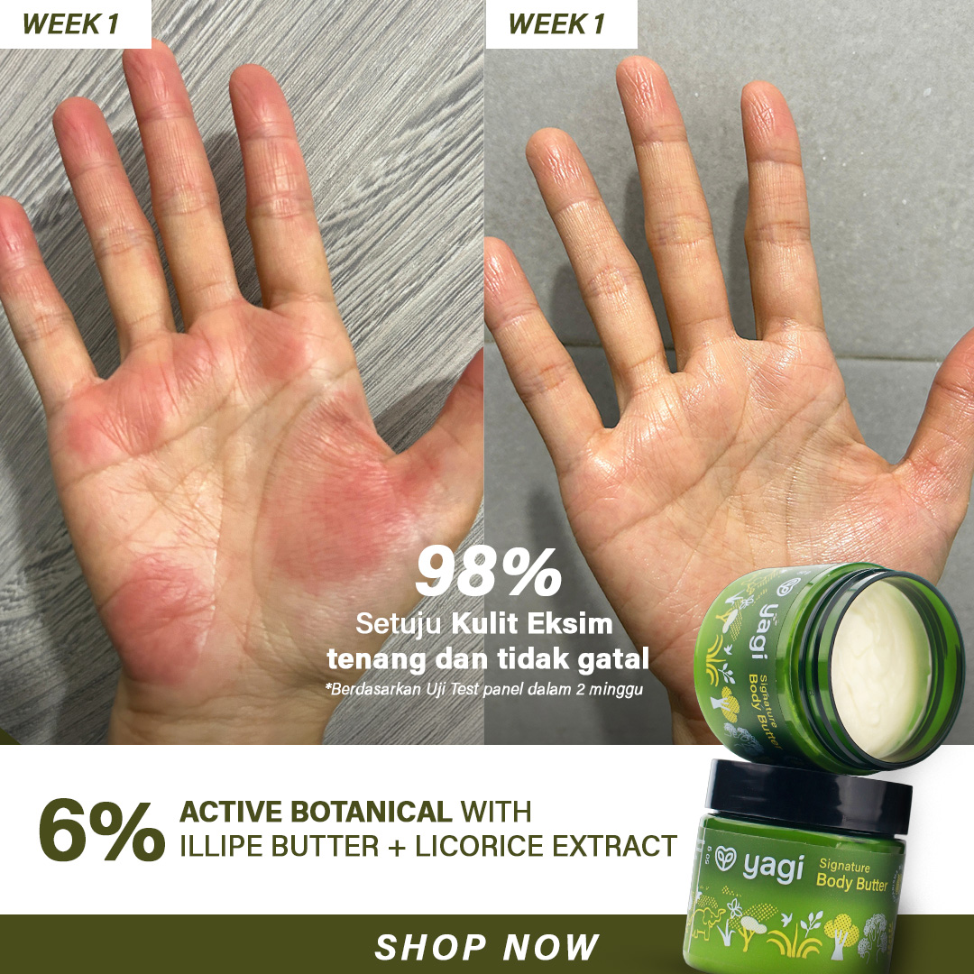YAGI Natural Facebook ad: Eksim basah? Iritasi merah? Redakan dari 1x pakai!