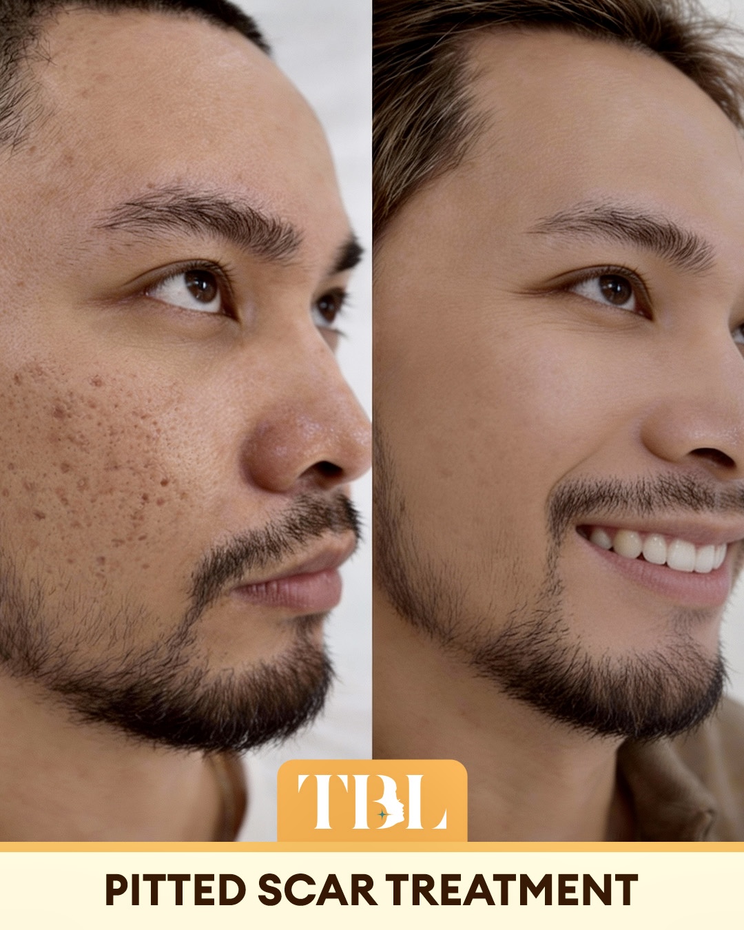 TBL Manila Aesthetics Makati Facebook ad: Express Acne Scar Treatment