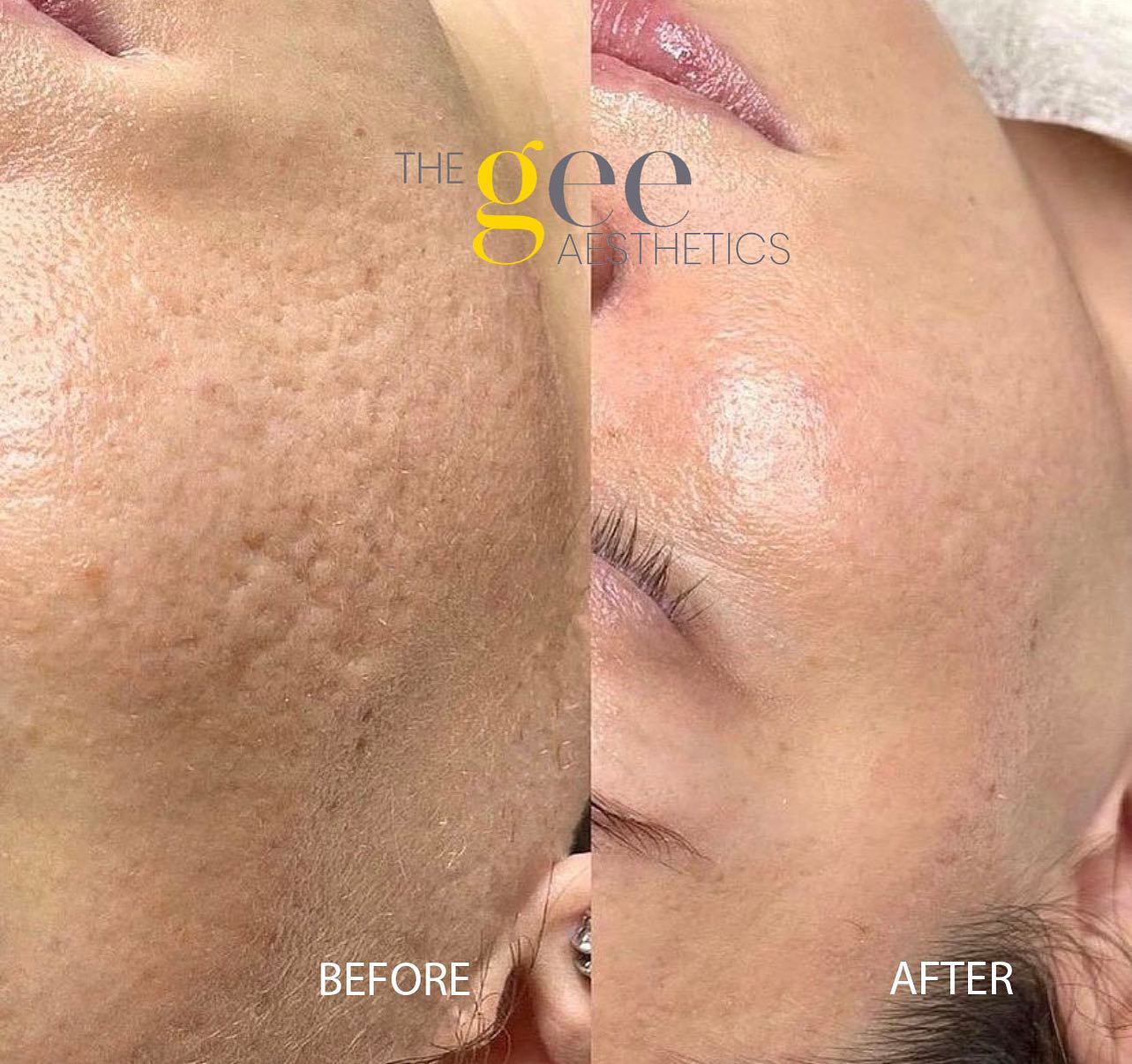 Lucky Sunrise Facebook ad: Ultra Fractional Treatment is a fractional laser technology…