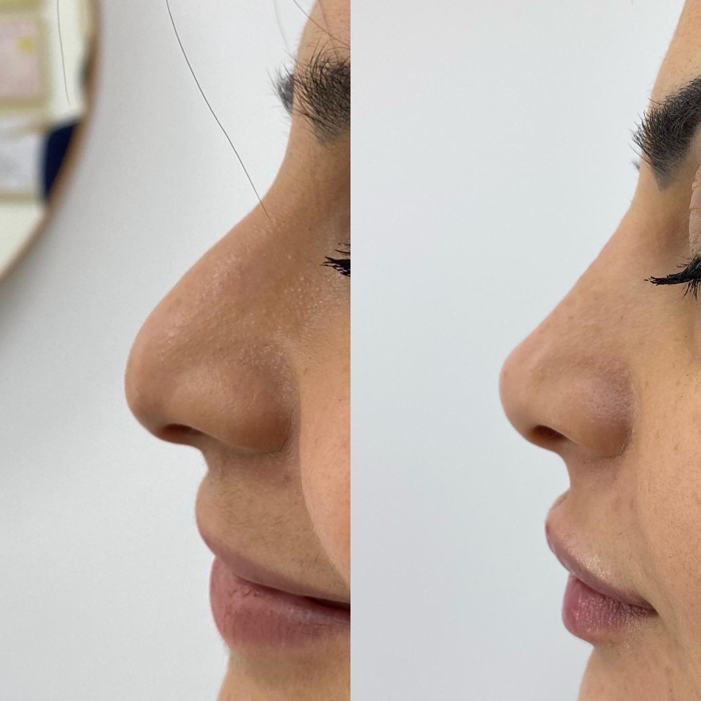 BeautyBar Facebook ad: None Surgical Rhinoplasty⁣⁣⁣⁣