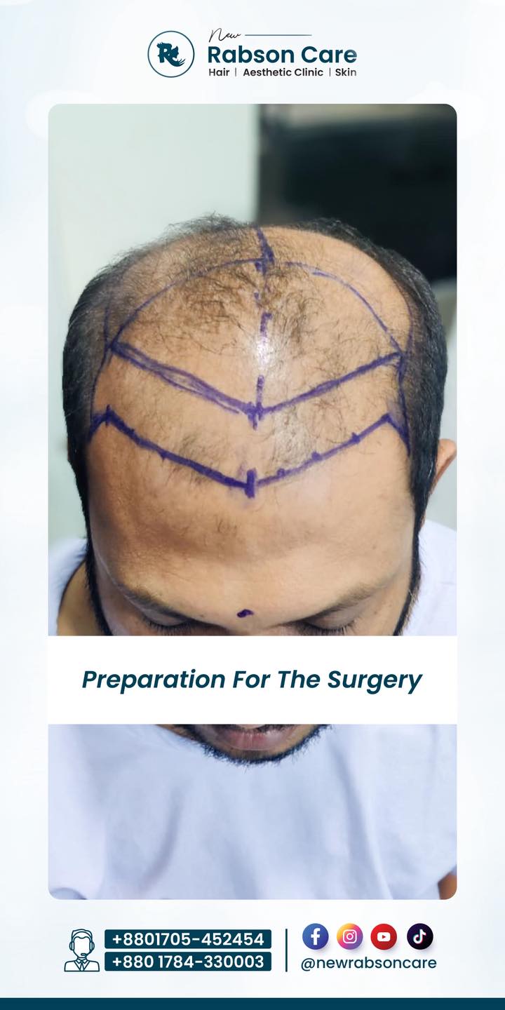 New Rabson Care Facebook ad: Hair Transplantation Update