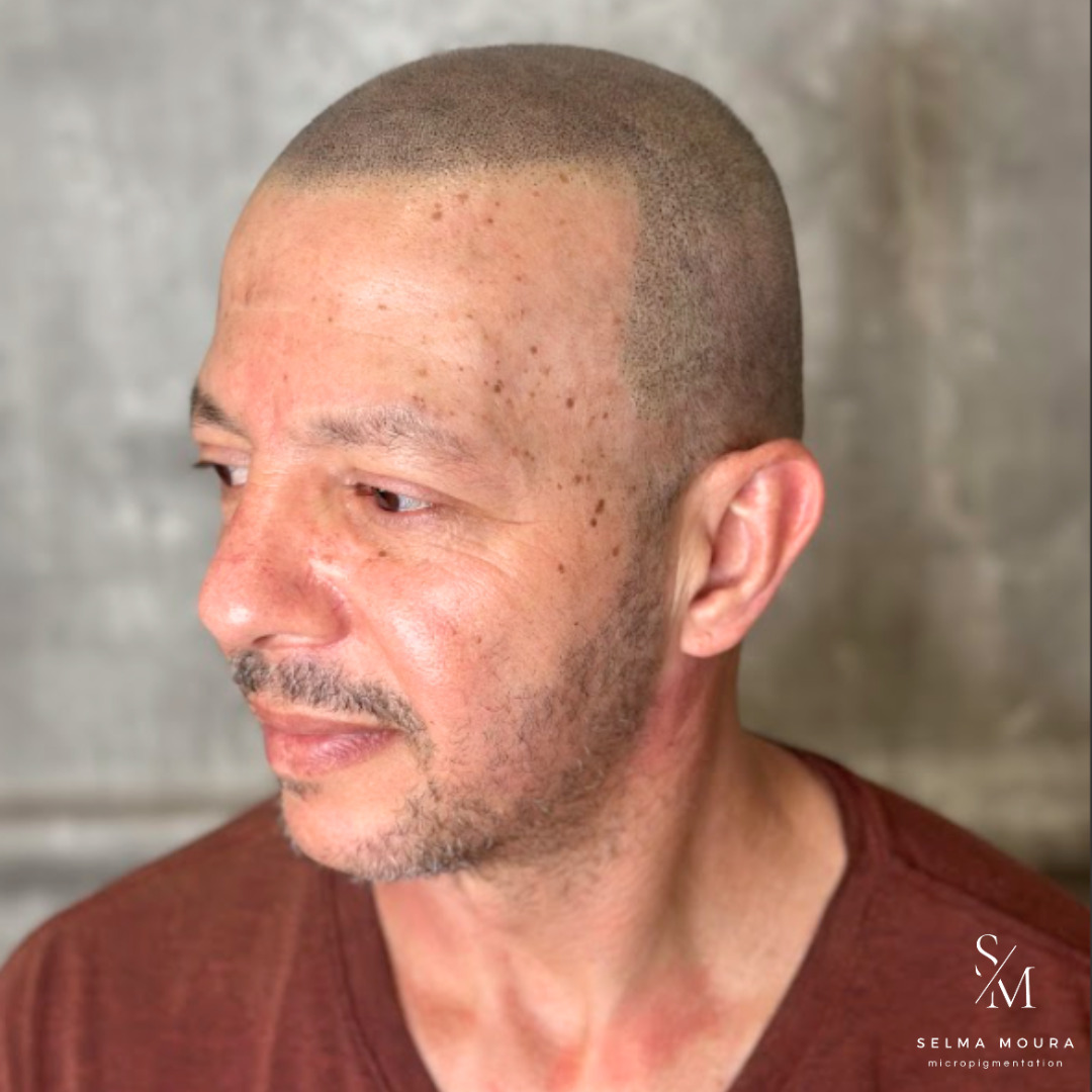 Hair Loss Solution Facebook ad: @selmamouramicropigmentacao