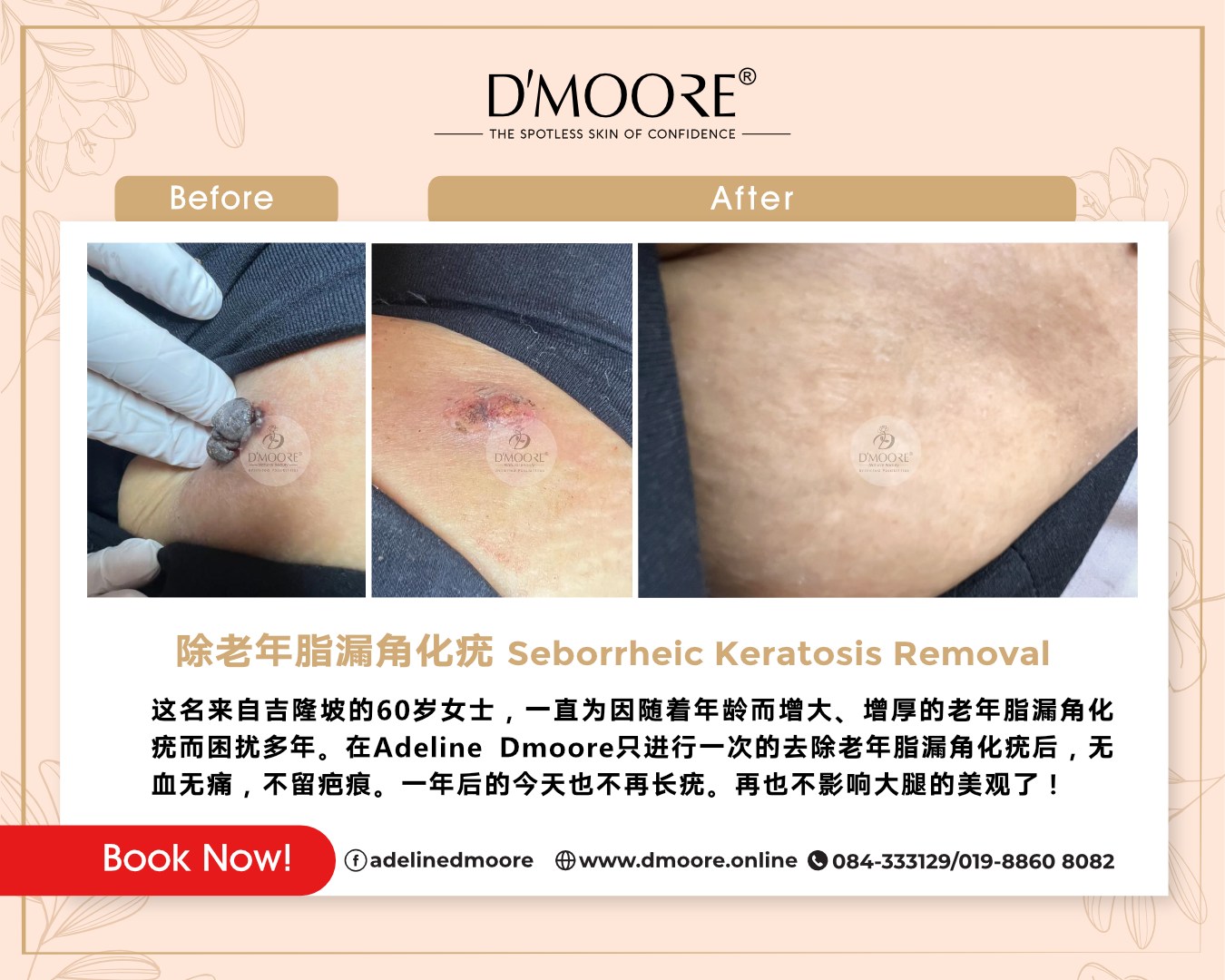D'moore 蓓蕾逖慕丽专科美容美体机构 Facebook ad