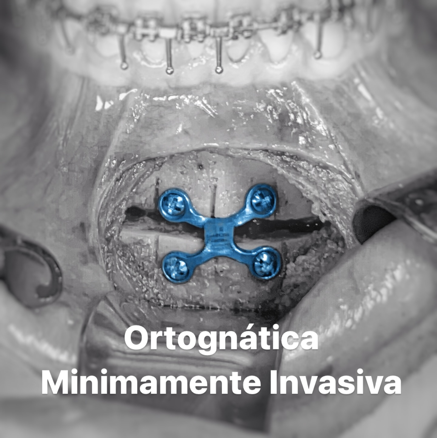 Dr Renato Sawazaki Facebook ad: O que é Cirurgia Ortognática Minimamente Invasiva?