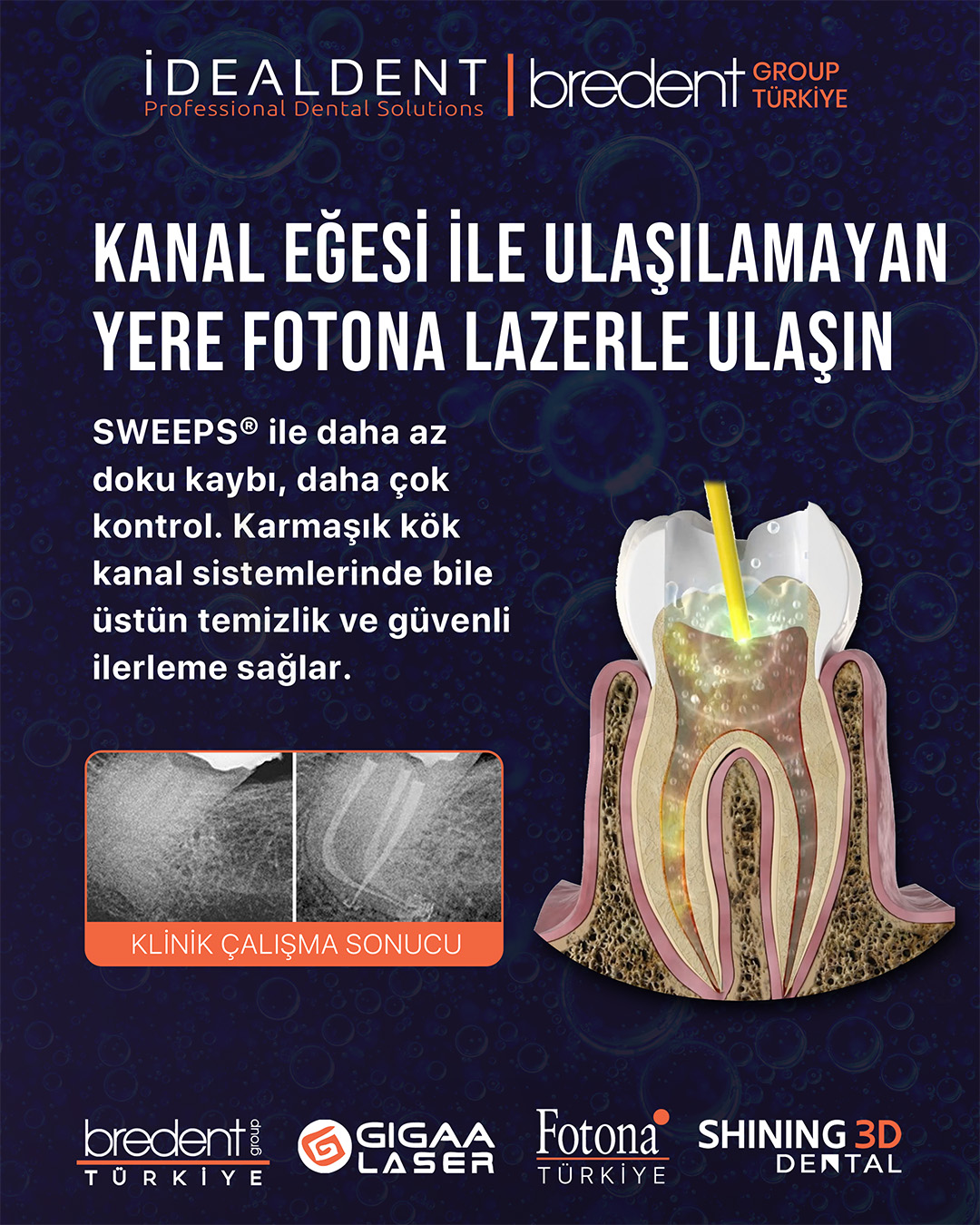 Bredent Tr Facebook ad