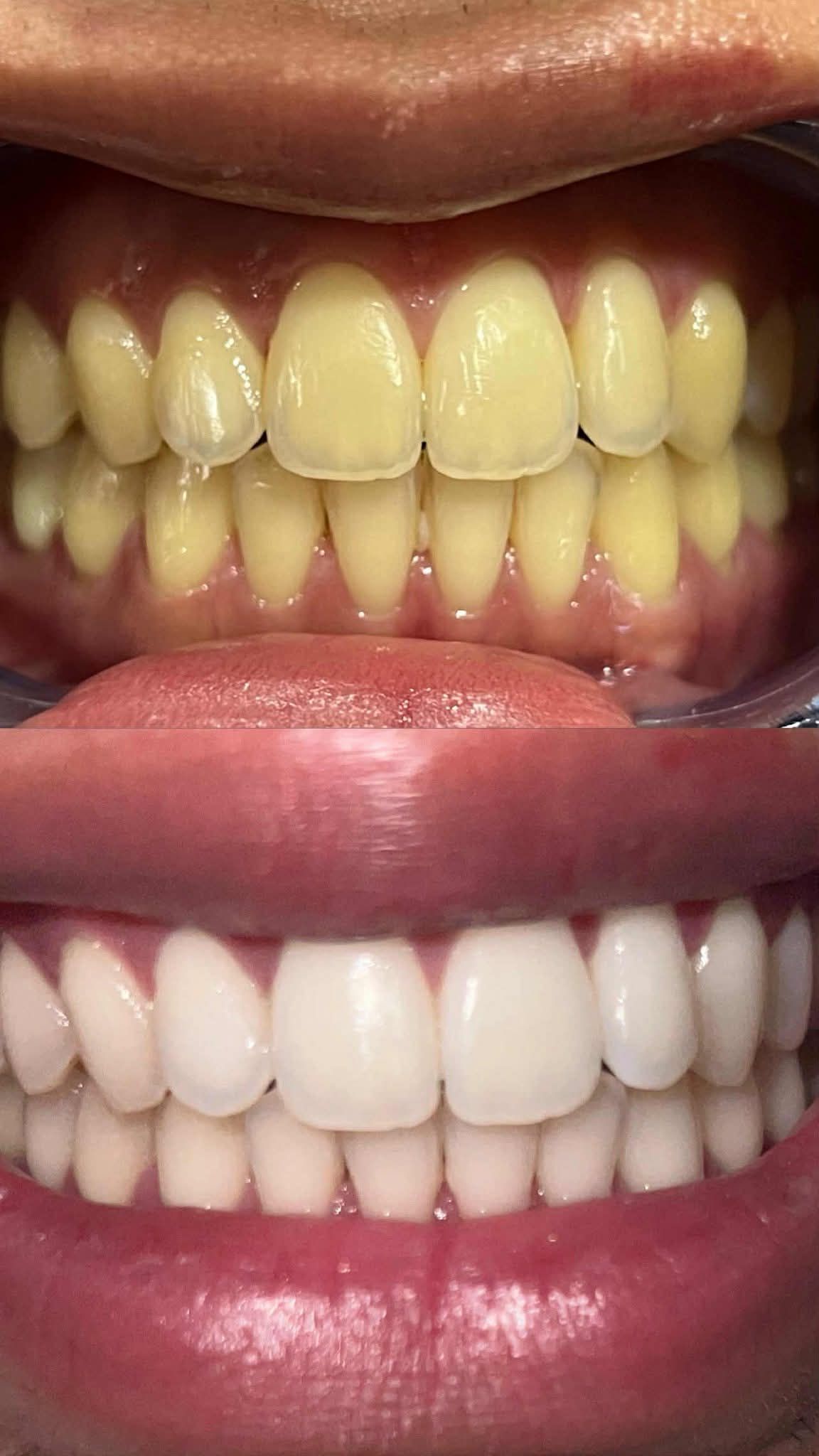 PMDCal Pampanga Facebook ad: Teeth whitening