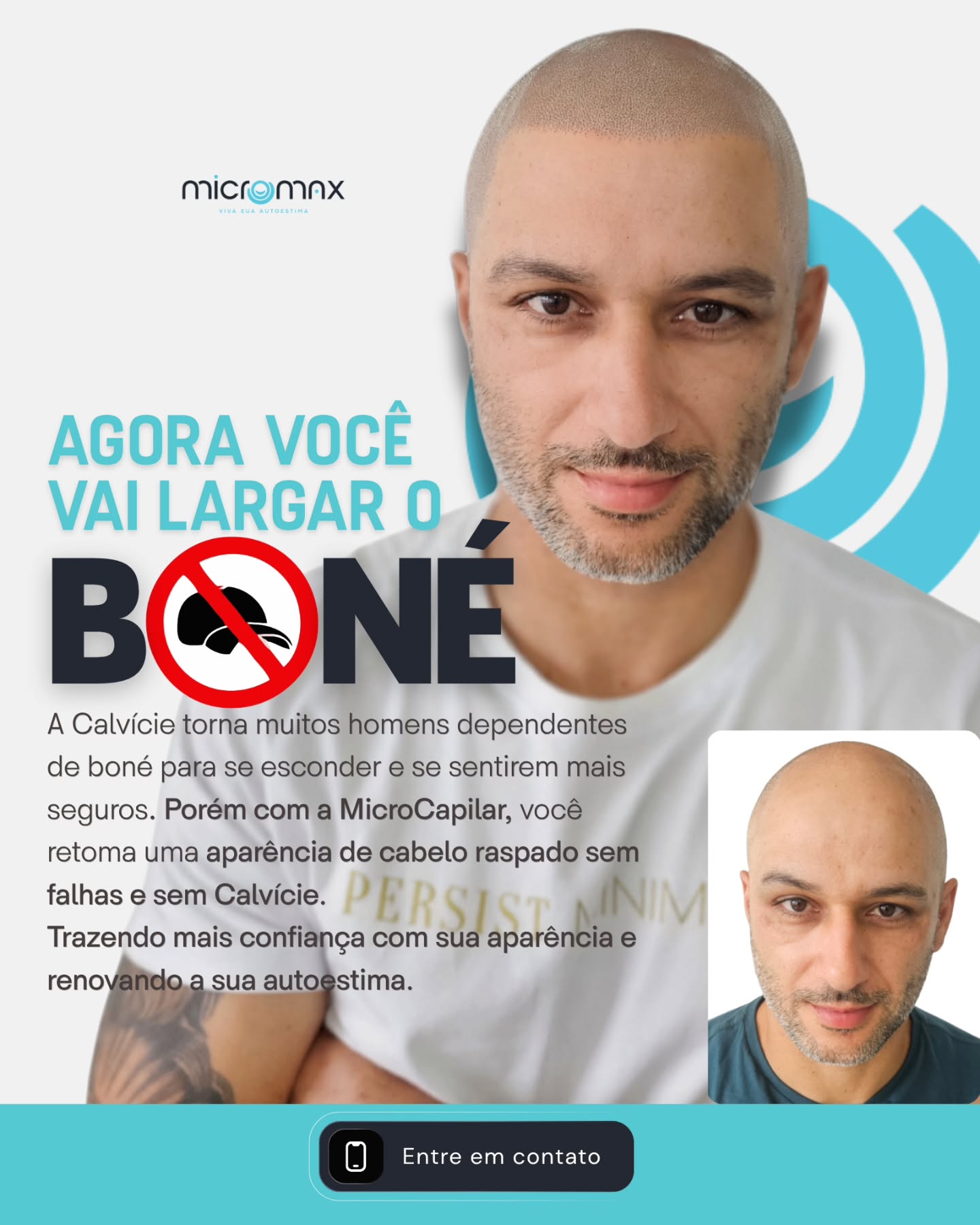 Micromax Micropigmentação Capilar Facebook ad