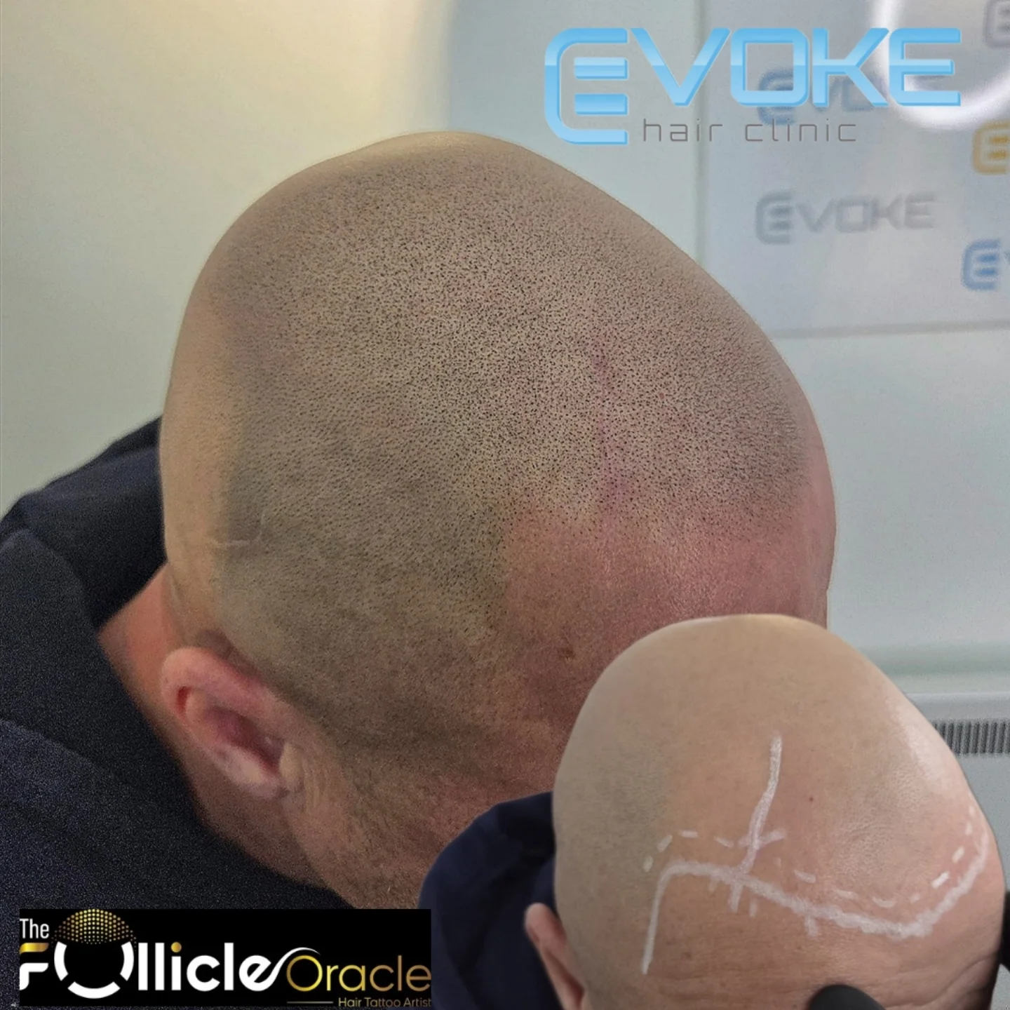 Evoke Hair Clinic Facebook ad: Hair loss can be a huge confidence drain…