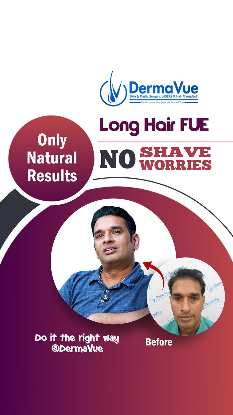 DermaVue Skin, Cosmetology & Hair Transplant Facebook ad: No Shave. No Stress.