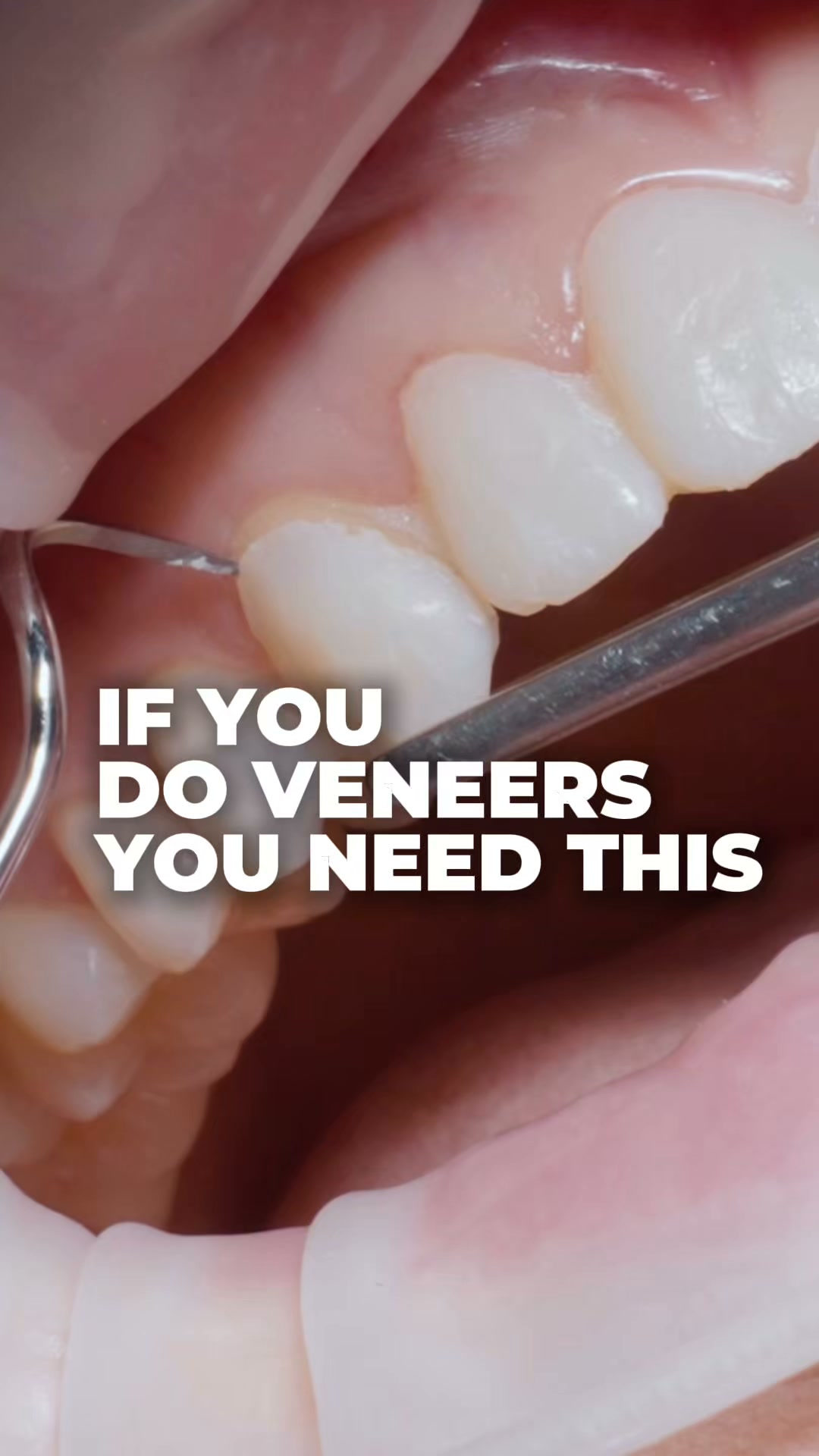 Dr. Volodymyr Kachmar Facebook ad: One Structured Veneer Workflow