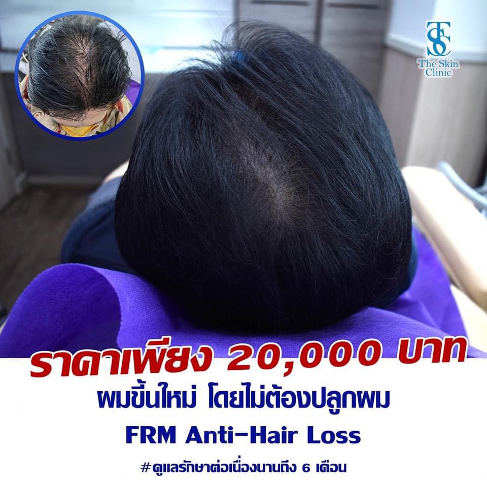 ปลูกผม Long Hair โดย หมอท็อป The skin clinic แพทย์อเมริกันบอร์ด Facebook ad
