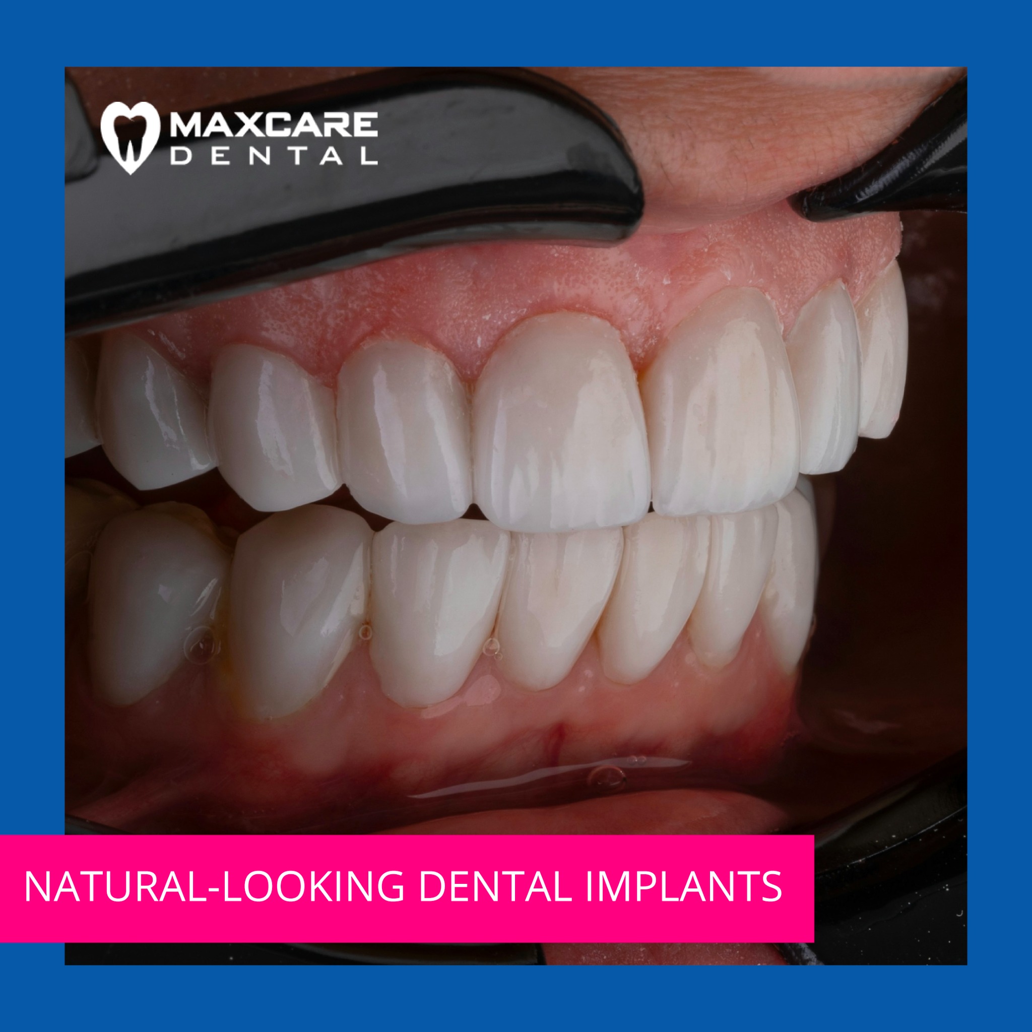 Maxcare Dental Clinic Facebook ad: Quality dental care that fits your budget!