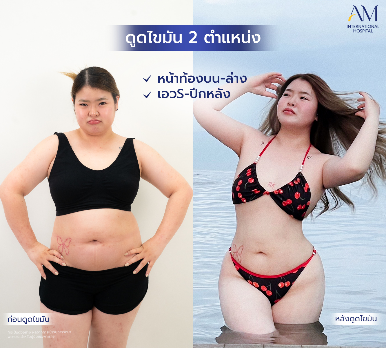 AM Liposuction for Plus Size โดยหมอไอซ์และทีมแพทย์ (โรงพยาบาลเฉพาะทาง) Facebook ad