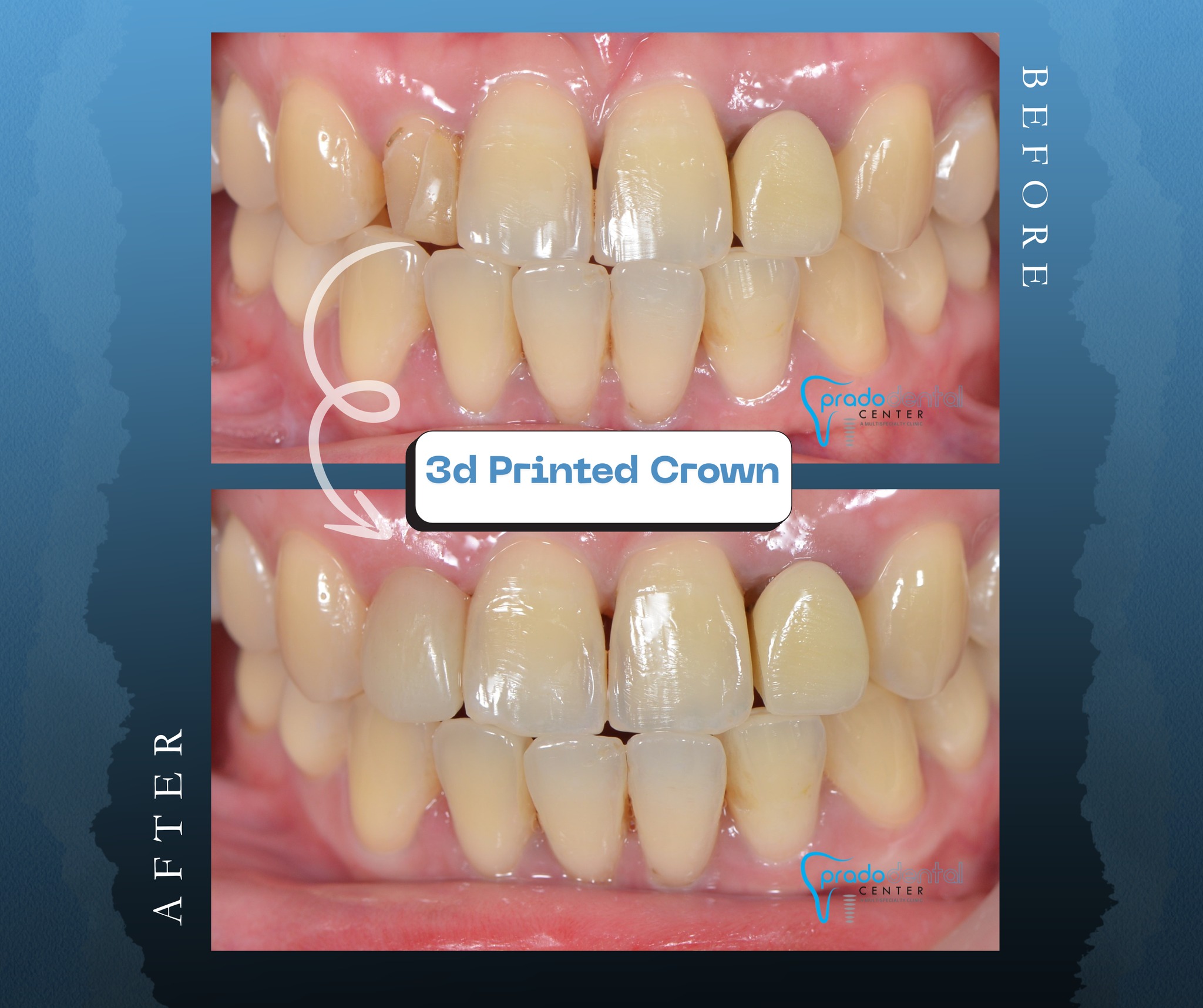 Prado Dental Center Facebook ad: Custom-designed, 3D-printed dental crowns for superior…