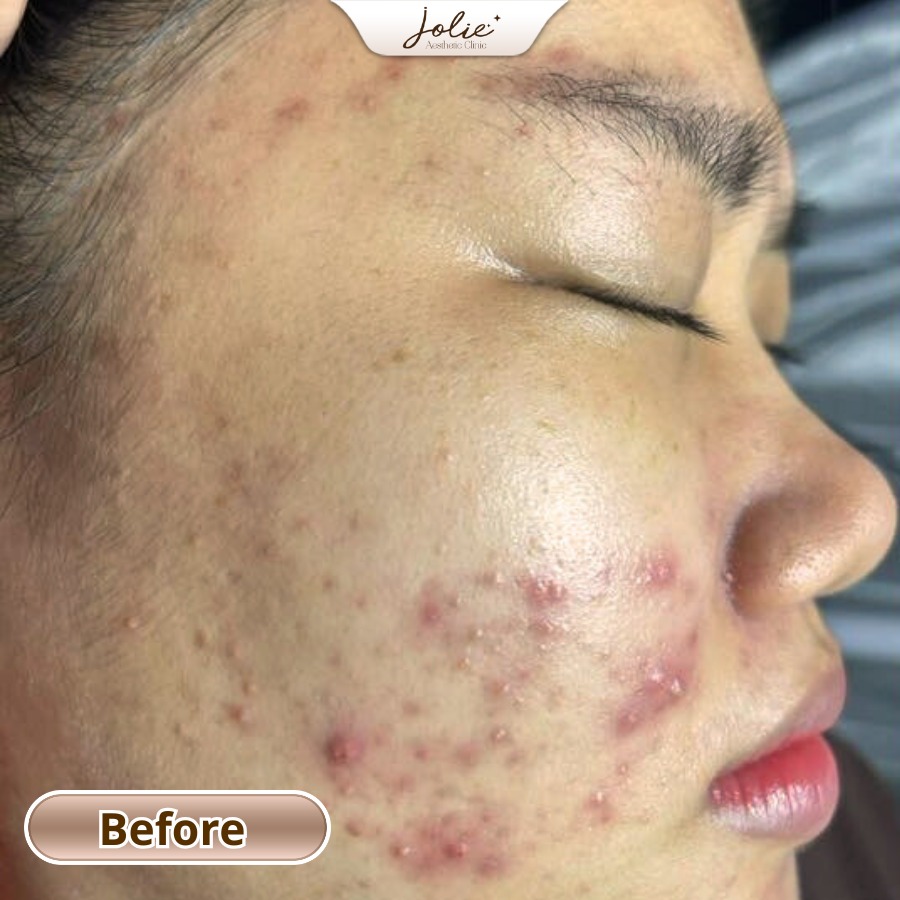 Jolie Skincare Spa Pampanga Facebook ad: FINAL