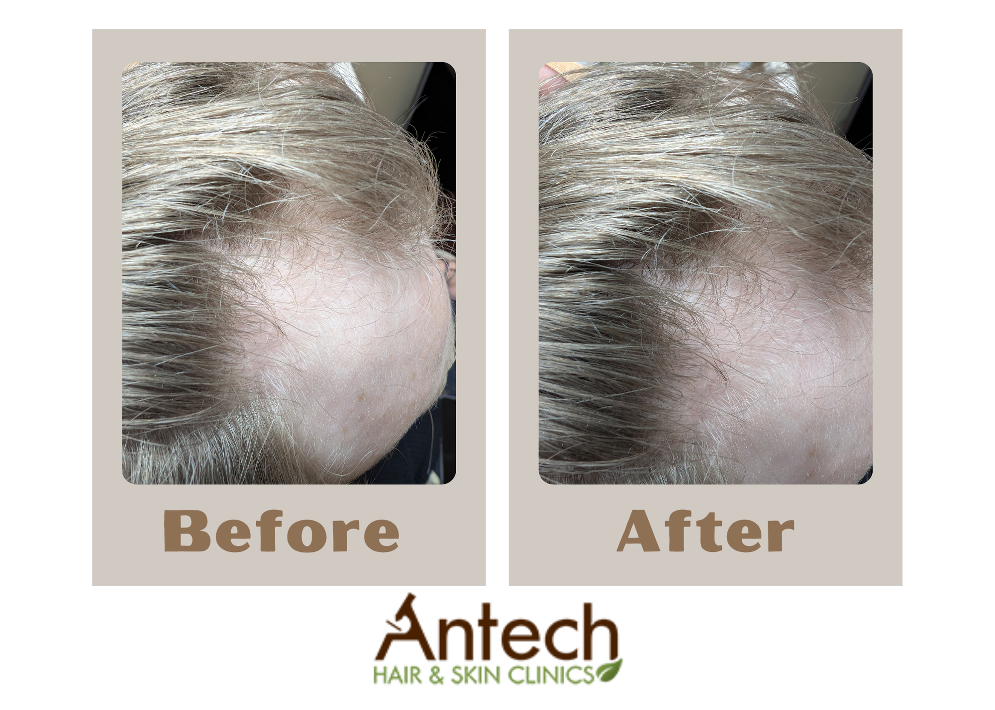 Antech Hair & Skin Clinic Facebook ad