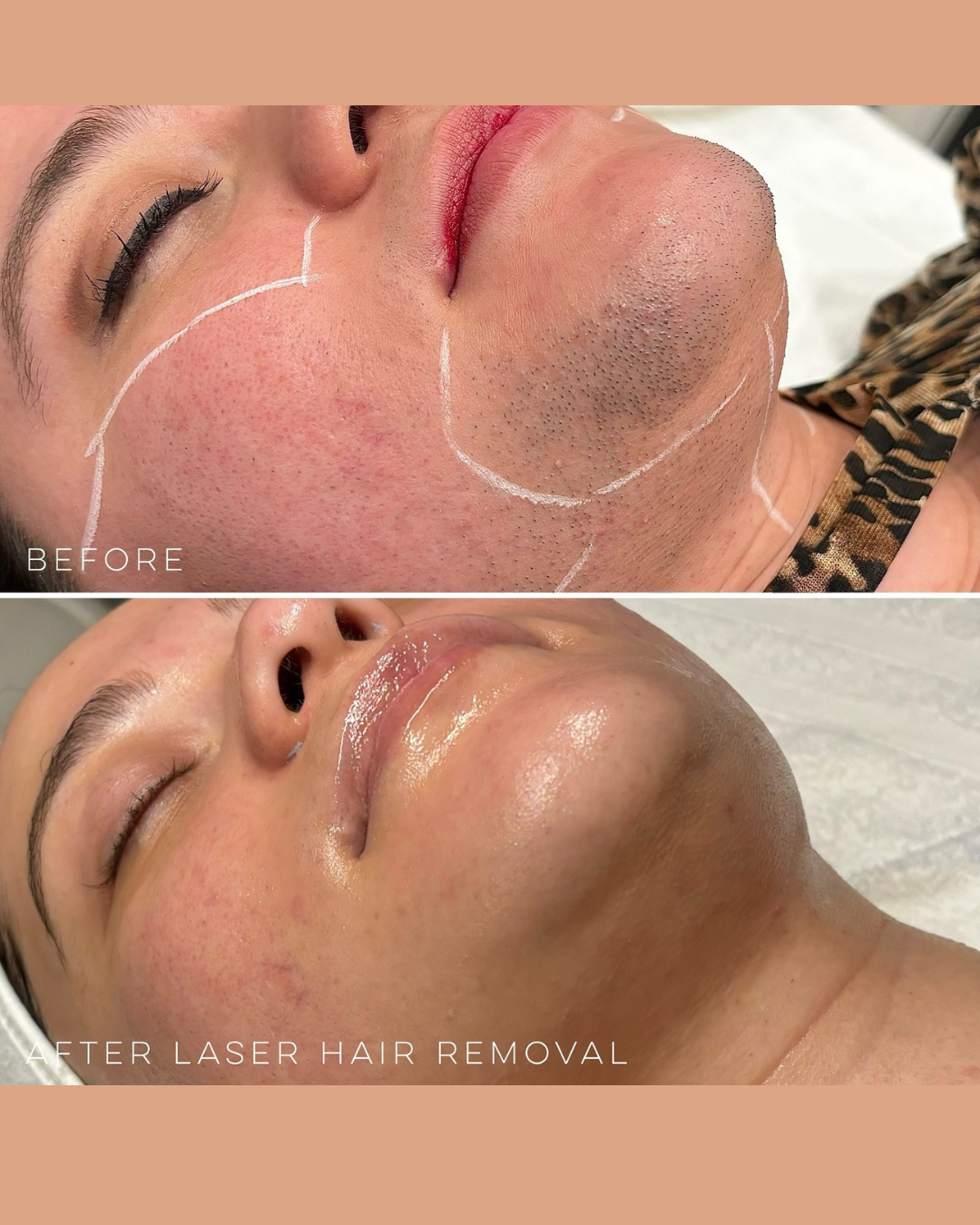 The Intimate Studio - Intimate waxing/laser hair removal specialist. Facebook ad: PCOS Consultation & Patch Test