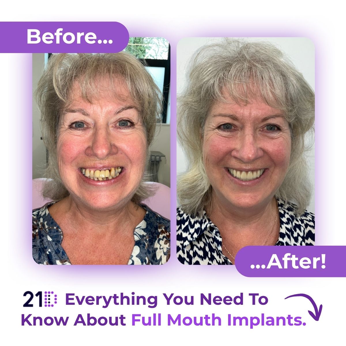 21D: Exclusively Full Jaw Implant Solutions Facebook ad