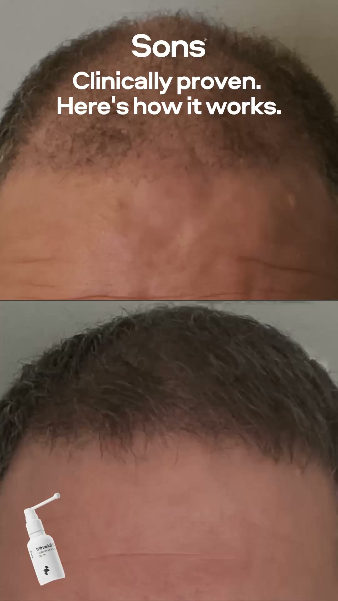 Sons Facebook ad: Your hairline. Your call.