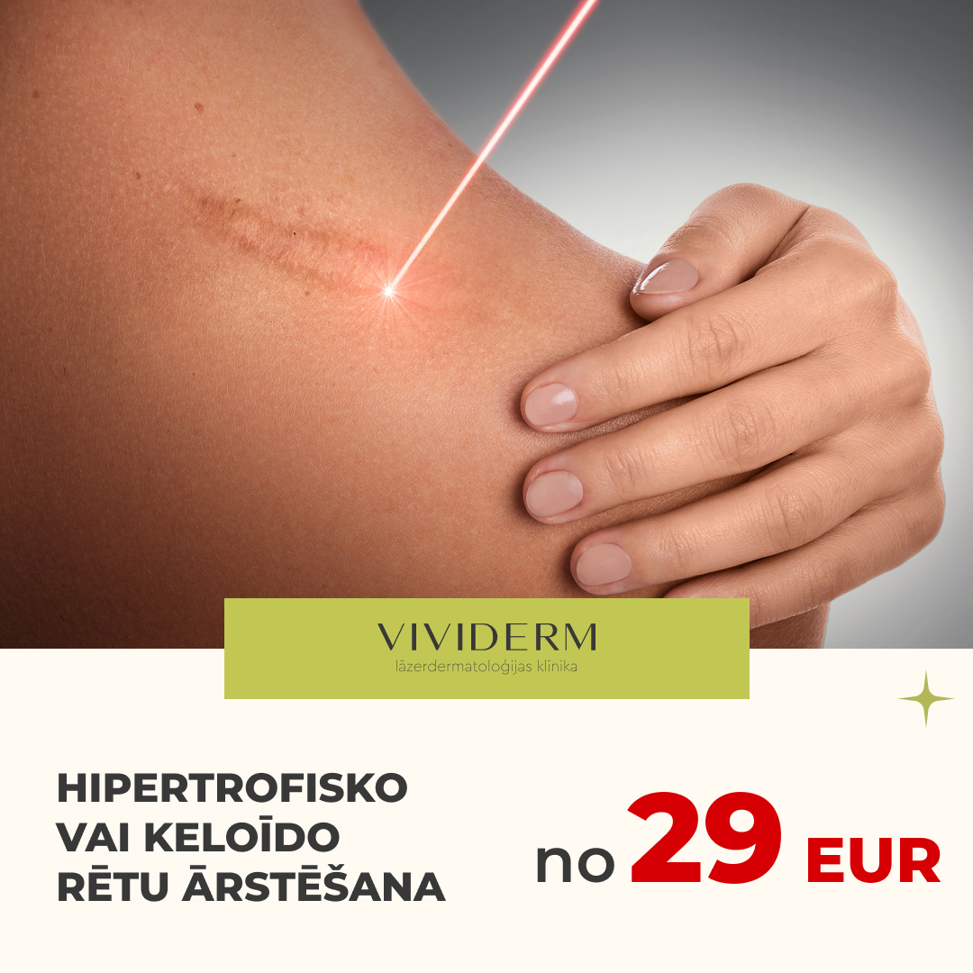 Vividerm Facebook ad: Vai rētas vai ādas veidojumi (papilomas, dzimumzīmes) rada…