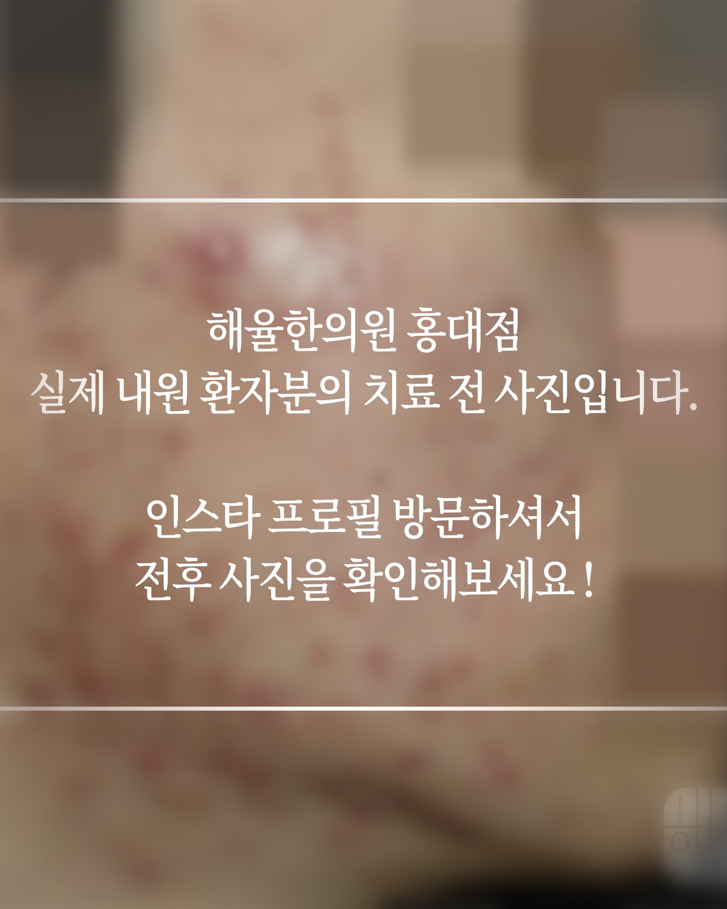 haeyul_hongdae Facebook ad: 다양한 여드름 발생 원인에 따른 개별 맞춤 진료를…