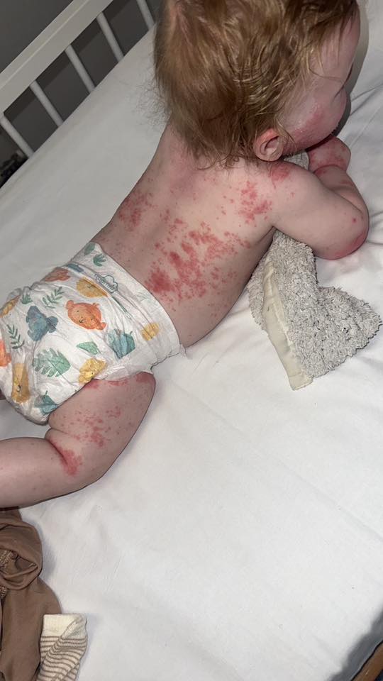 Jessica Rossi Facebook ad: Read this if your baby has eczema