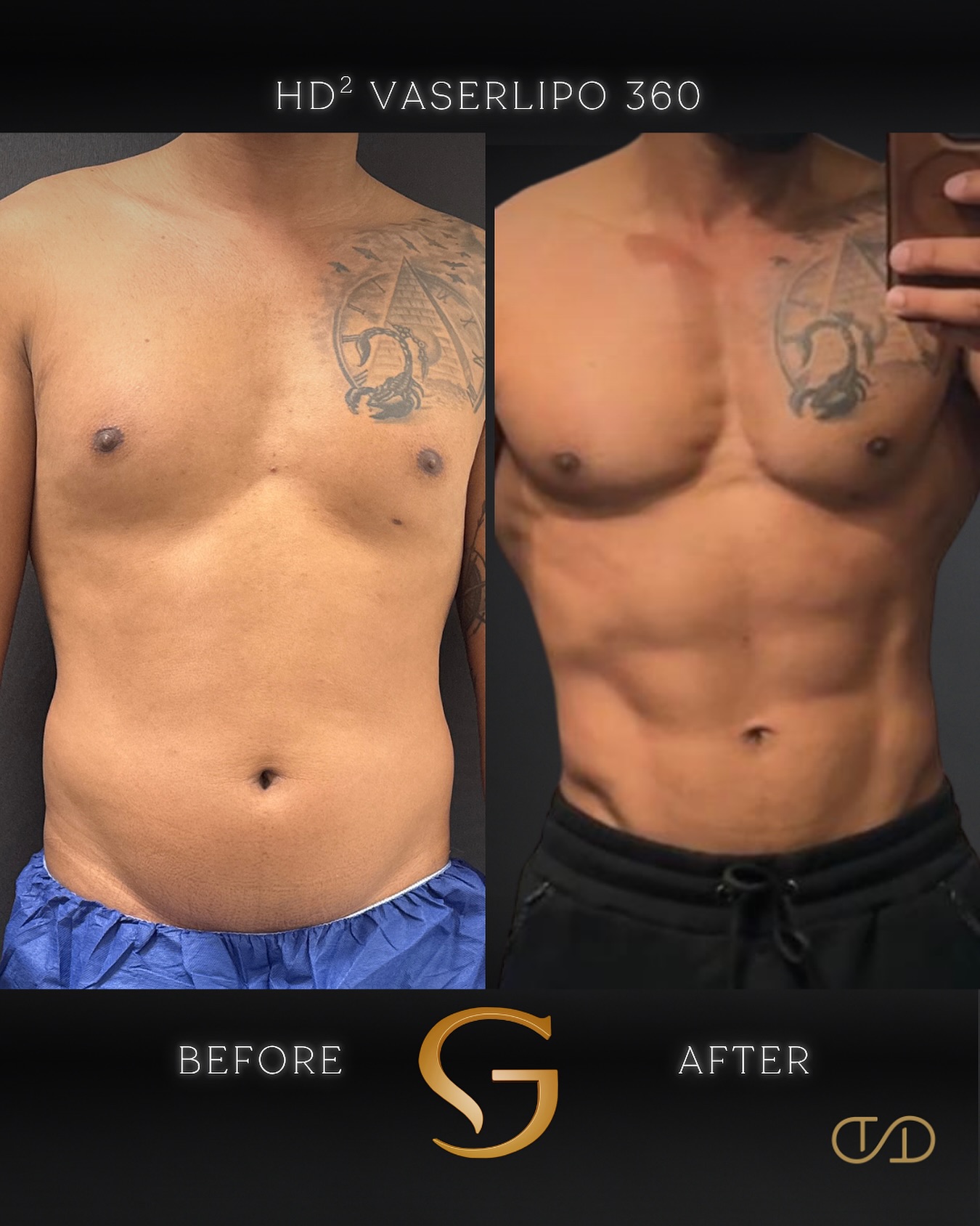 Dr.Gelb Facebook ad: Not all high-definition liposuction is created equal.