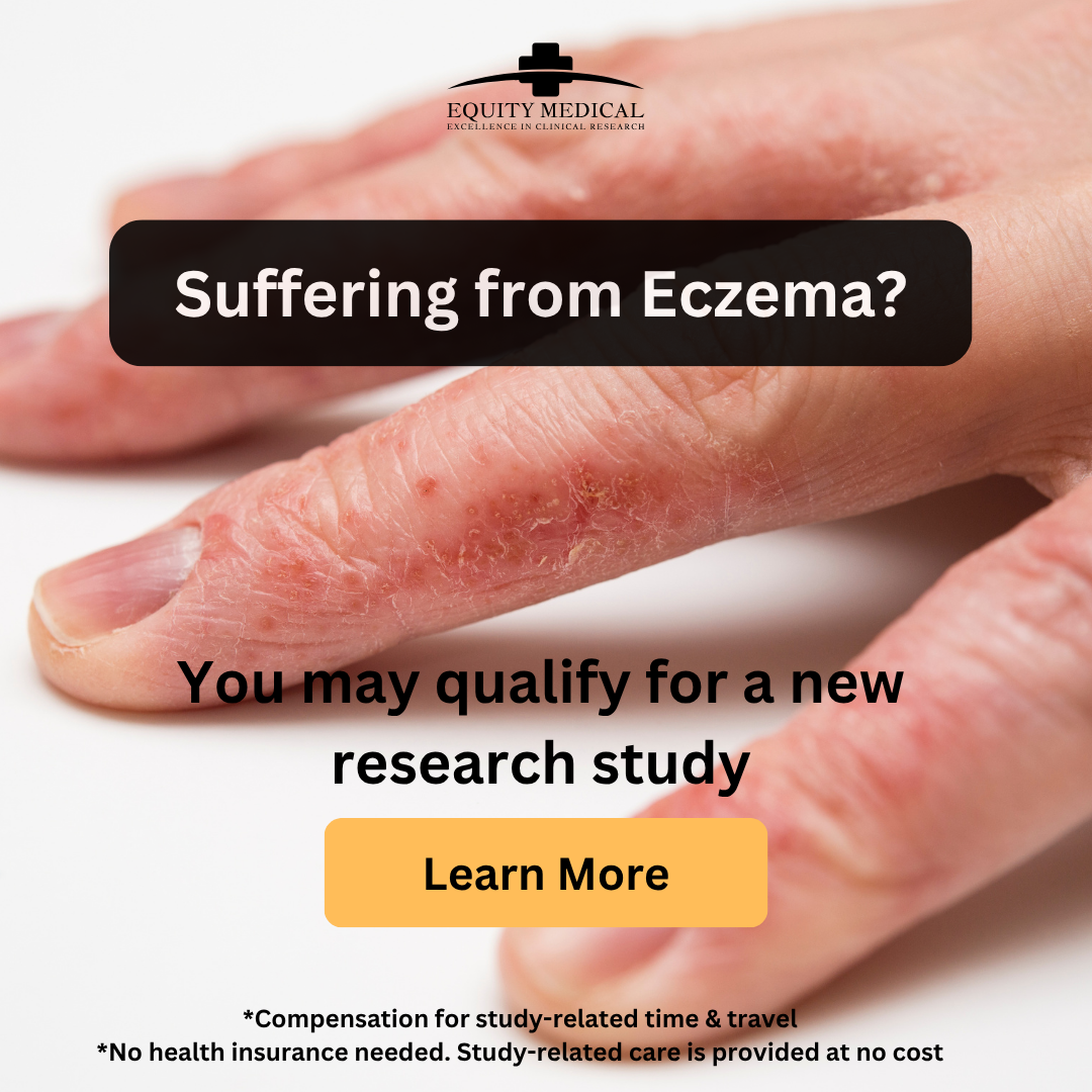 Equity Medical Facebook ad: Get Up to $1,350 for Eczema Study