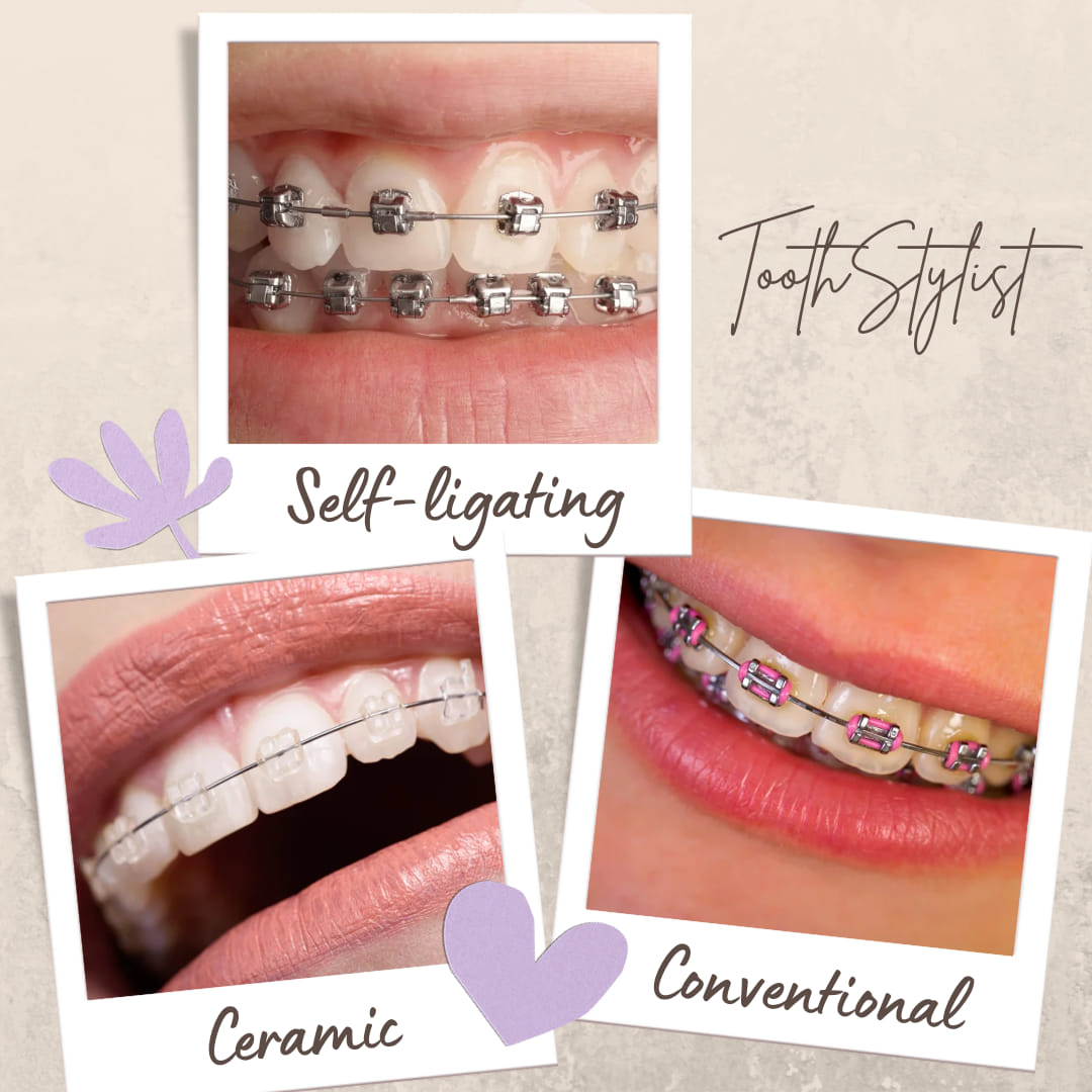 ToothStylist Dental Clinic Facebook ad: Why Get Braces