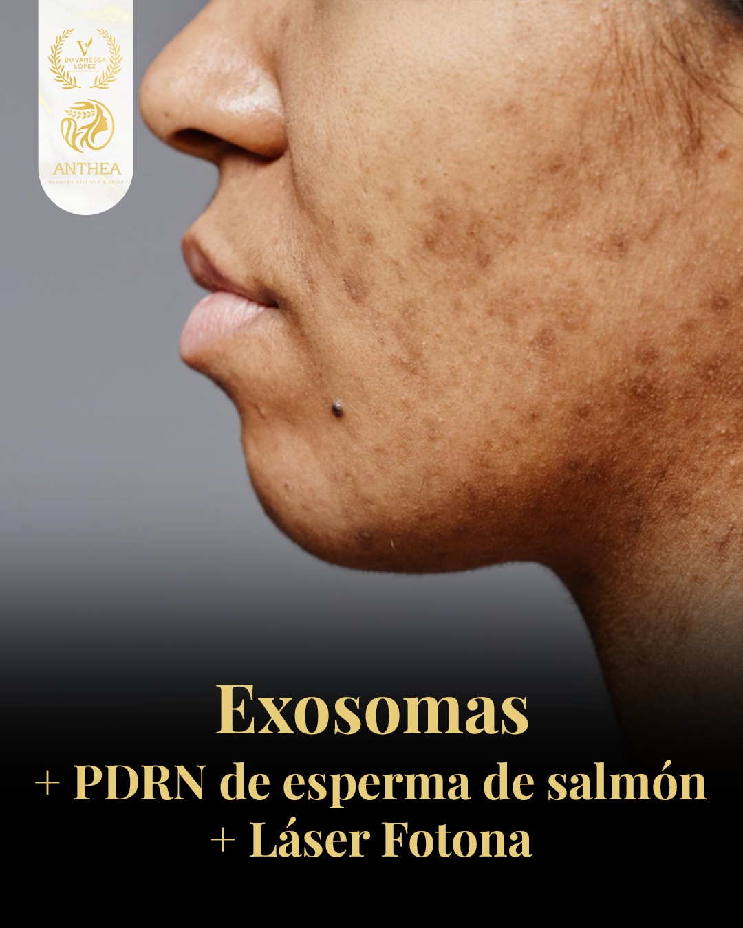 Anthea Facebook ad: Despídete de las manchas y dale a tu…
