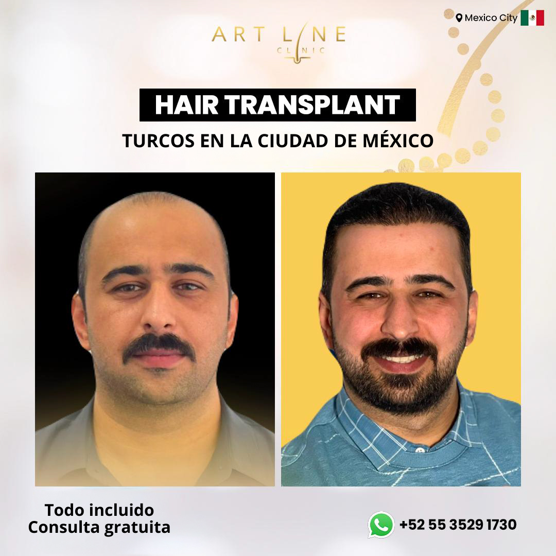 Art Line Hair Clinic CDMX Facebook ad: Agenda tu valoración