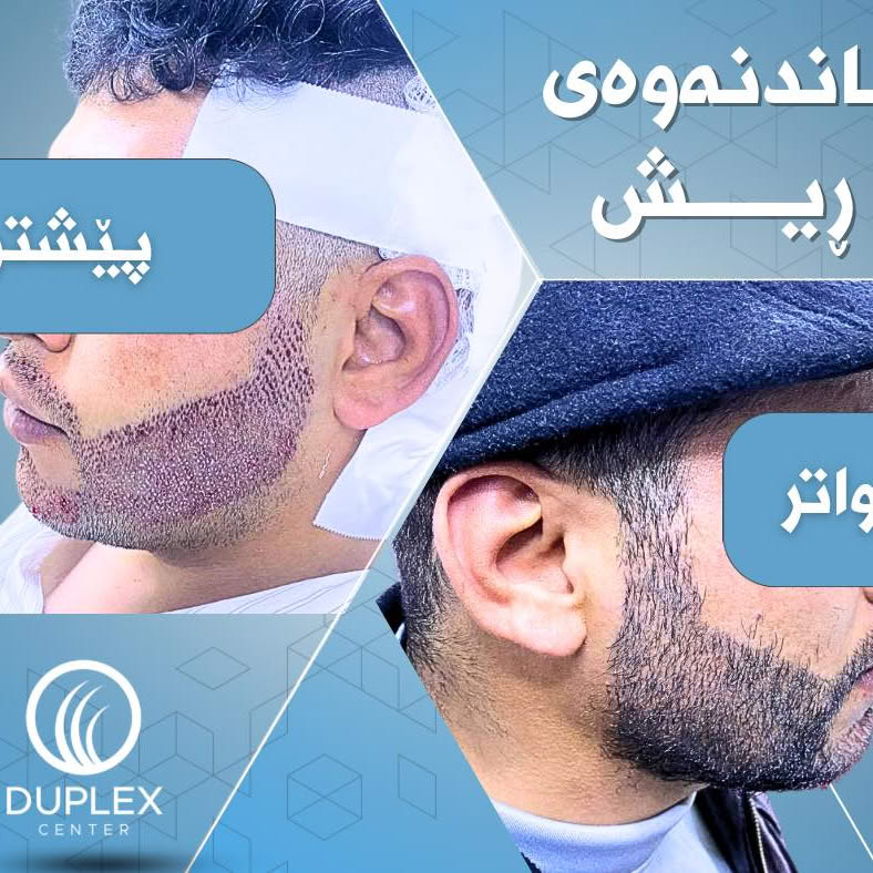 Duplex hair transplant Facebook ad from Sep 2, 2025