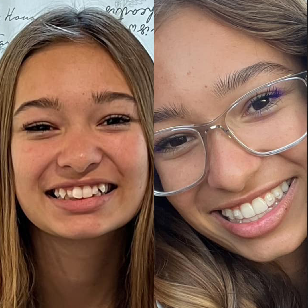 Invisalign Facebook ad
