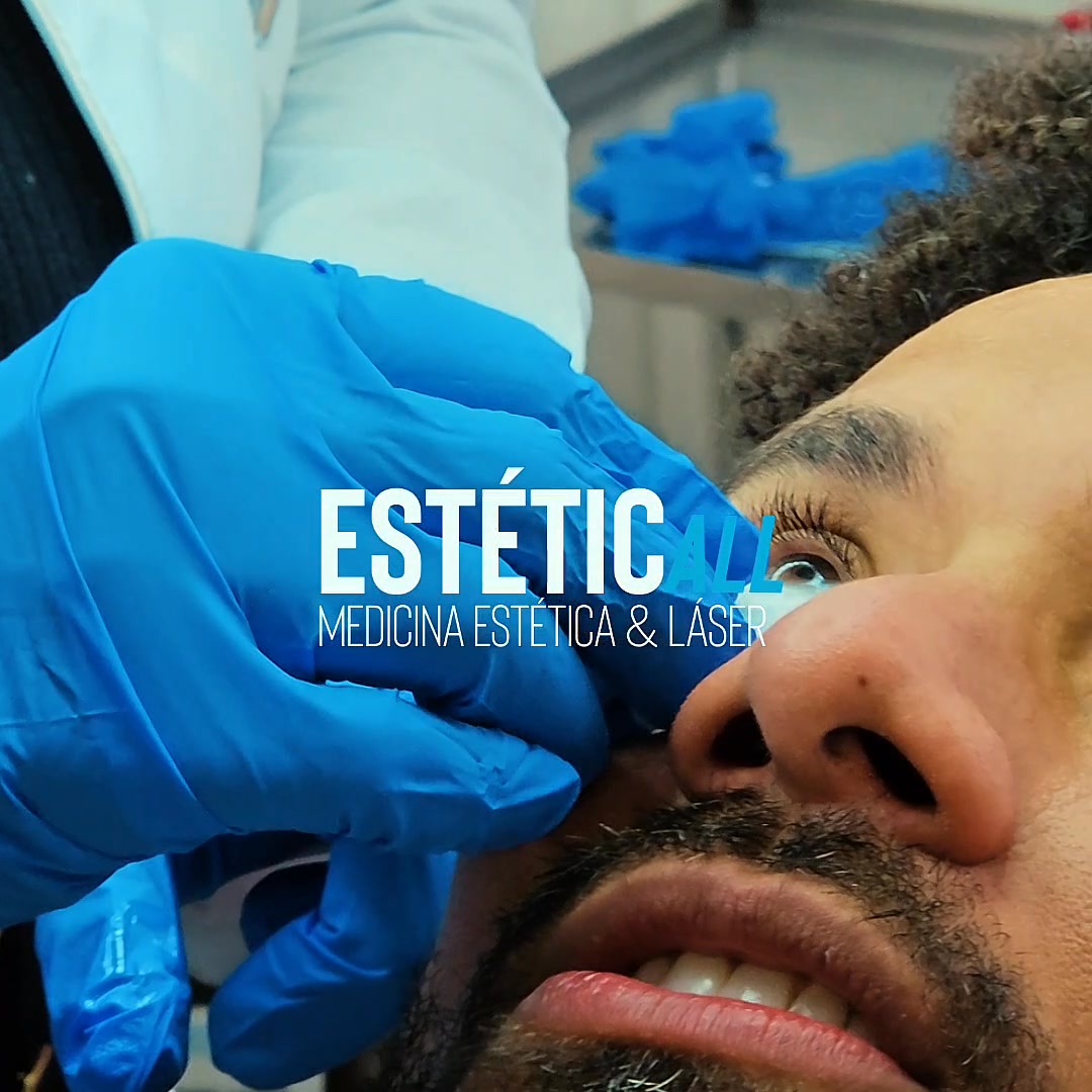 Esteticall Laser Facebook ad: Remoción de Lunares por Especialistas