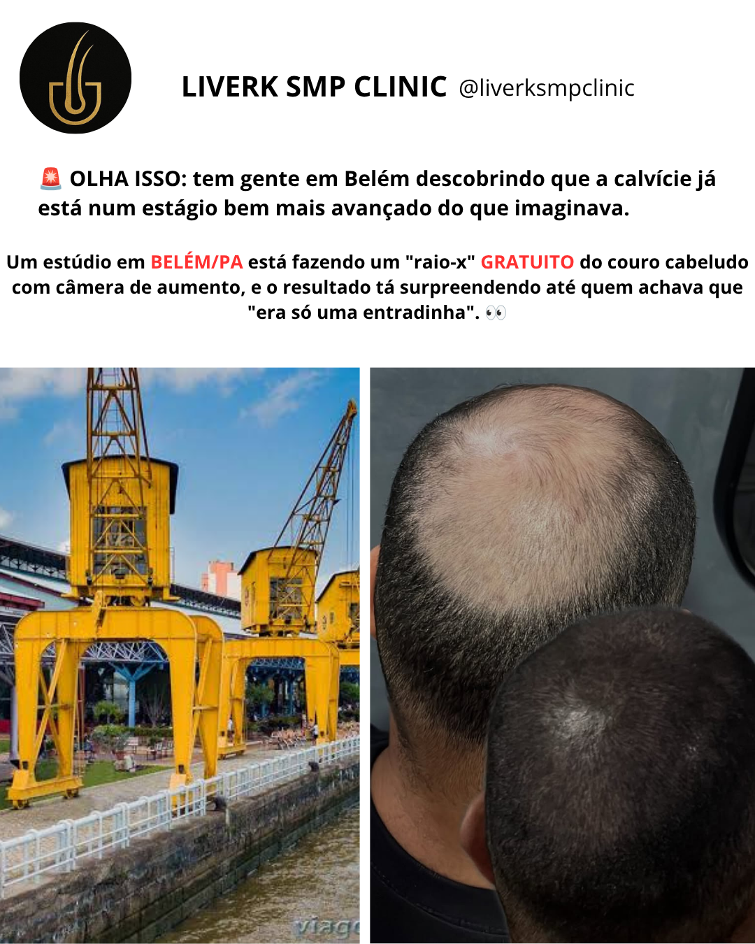 Breno Kaiê - Micropigmentação capilar Facebook ad: Entre Em Contato