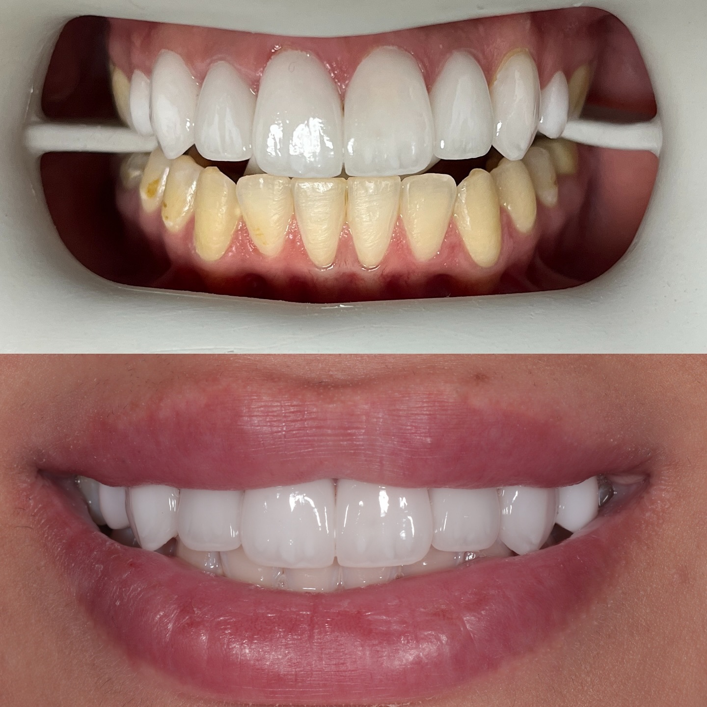All Smiles Dental Clinic Facebook ad: 40% off teeth whitening by Zoom4