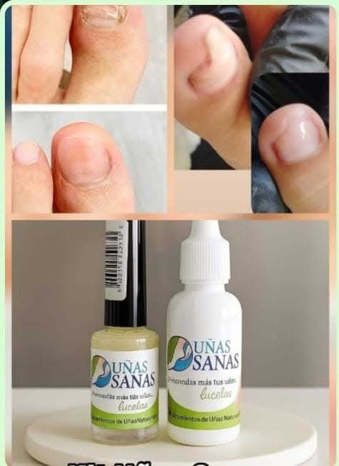Tratamientos Naturella Facebook ad: kit Antimicótico especial para hongos en las uñas.
