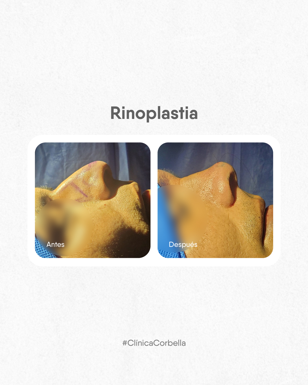 Clínica Dr. Corbella Facebook ad: Te mostramos un antes y después de un…