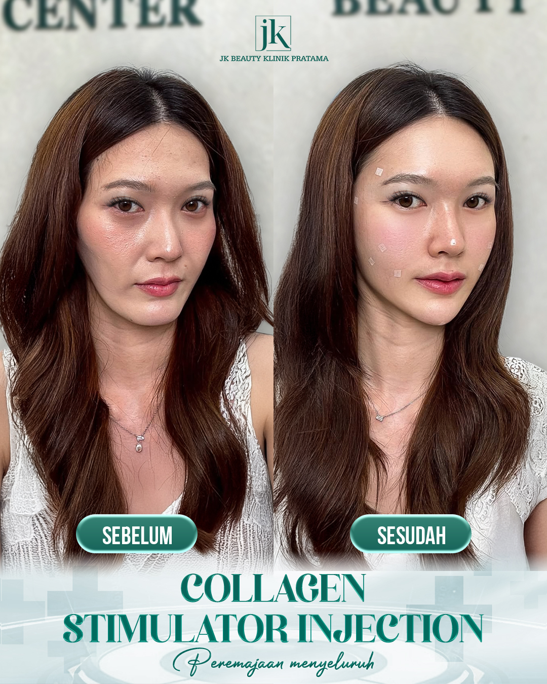 Collagen Stimulator Injection - JK Beauty Klinik Pratama Facebook ad: Mengapa wajah terlihat cekung dan kurang penuh seiring…