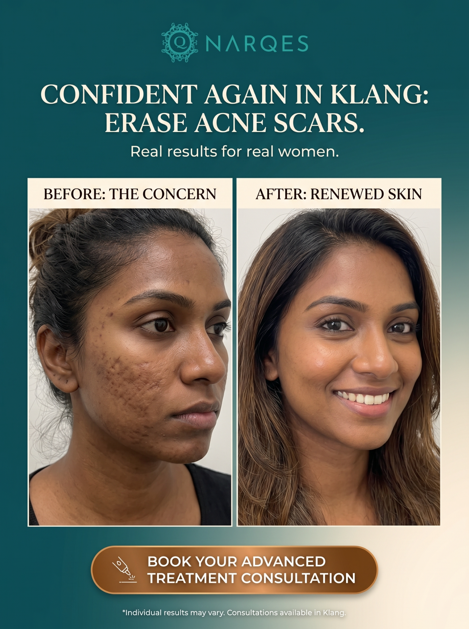 Narqes Aesthetics Klang Facebook ad: Reclaim Your Flawless Skin in Klang! Bye-Bye Acne Scars.