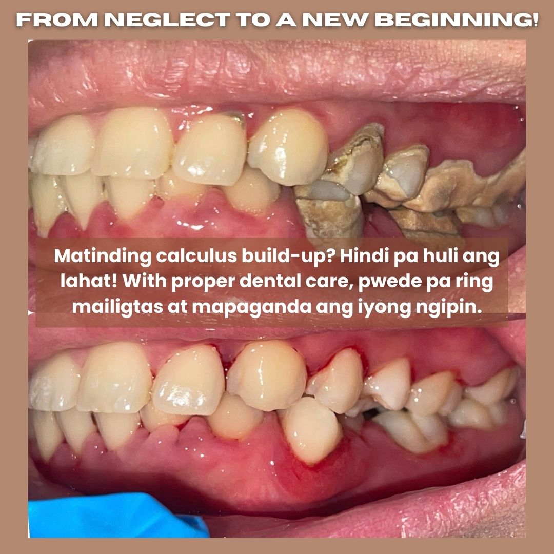Rey Dental Clinic Facebook ad: Severe Tartar Buildup? Don’t Wait ‘Til It’s Too Late!