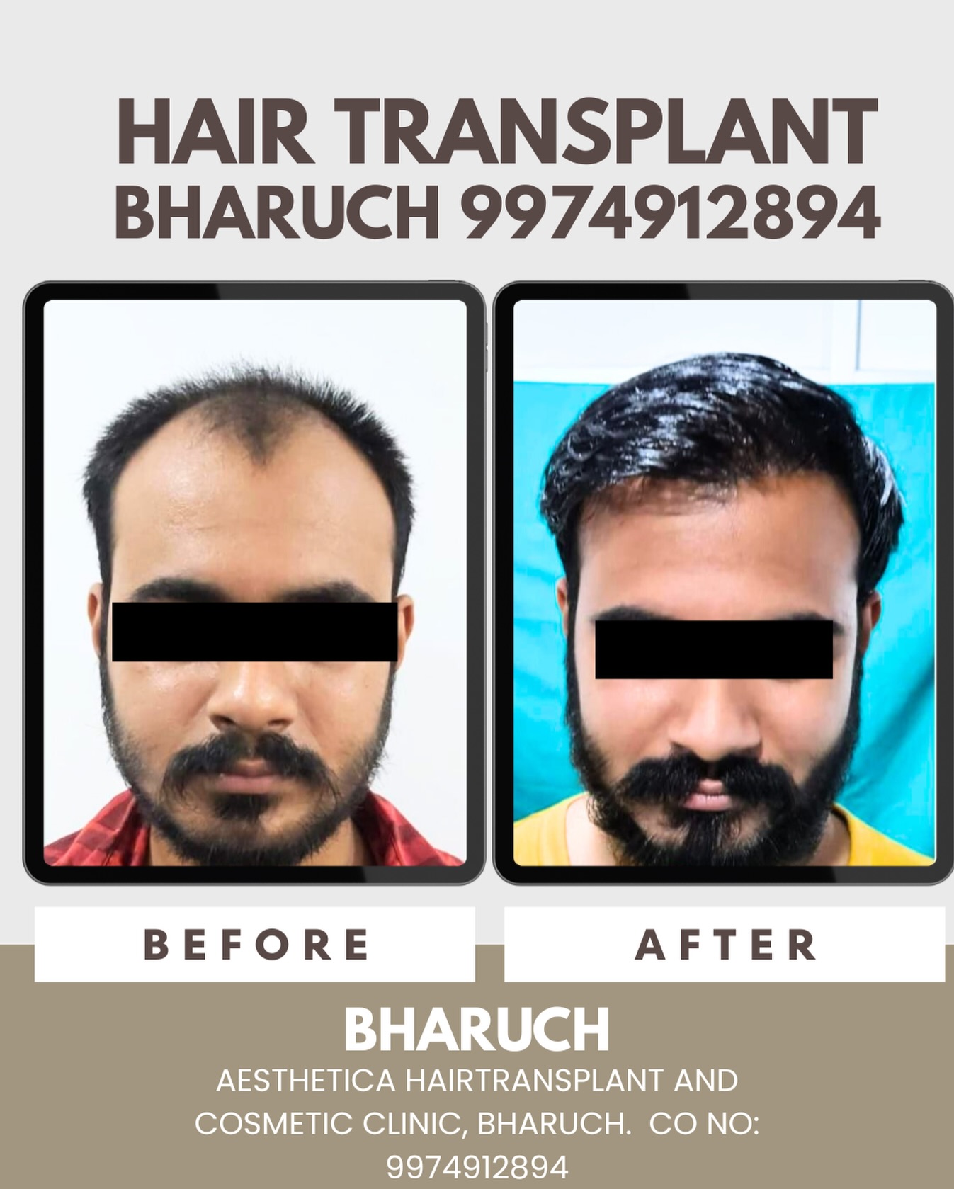 Cosmetic clinic Bharuch Facebook ad: Receding hairline ya bald patches?