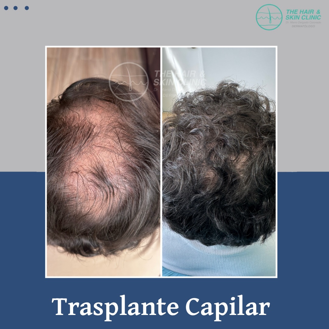 The Hair and Skin Clinic Facebook ad: ¿Buscas recuperar la densidad de tu cabello?