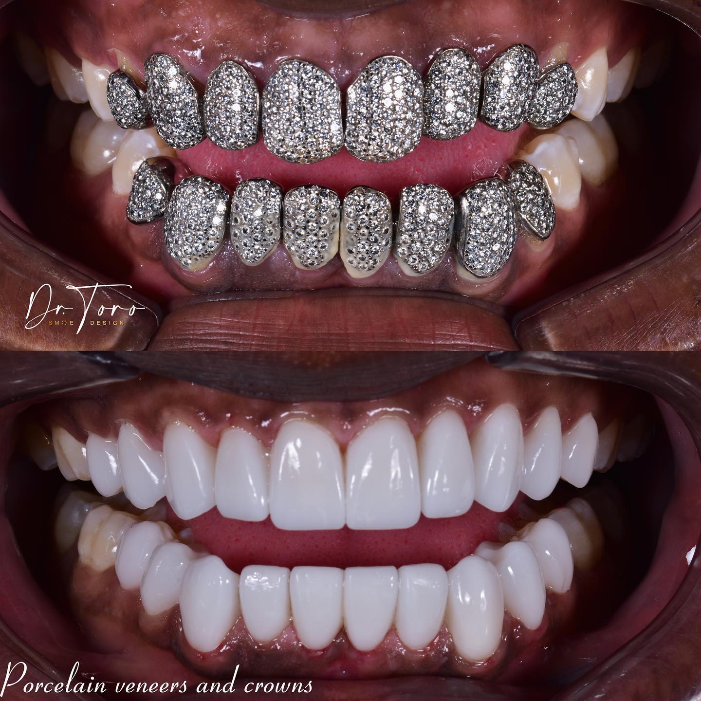 Dr Toro Smile Design Facebook ad: Whatsapp +57 315 3391321 or Dm for more…
