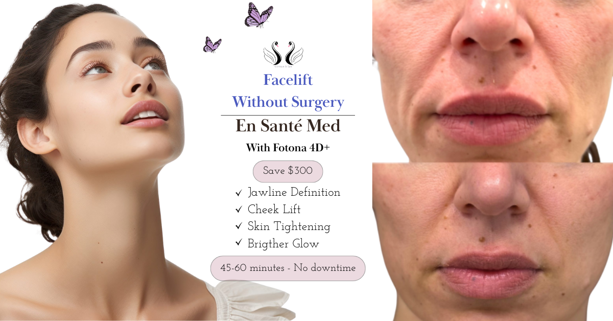 En Santé Med Facebook ad: Enjoy $300 off Lift without surgery
